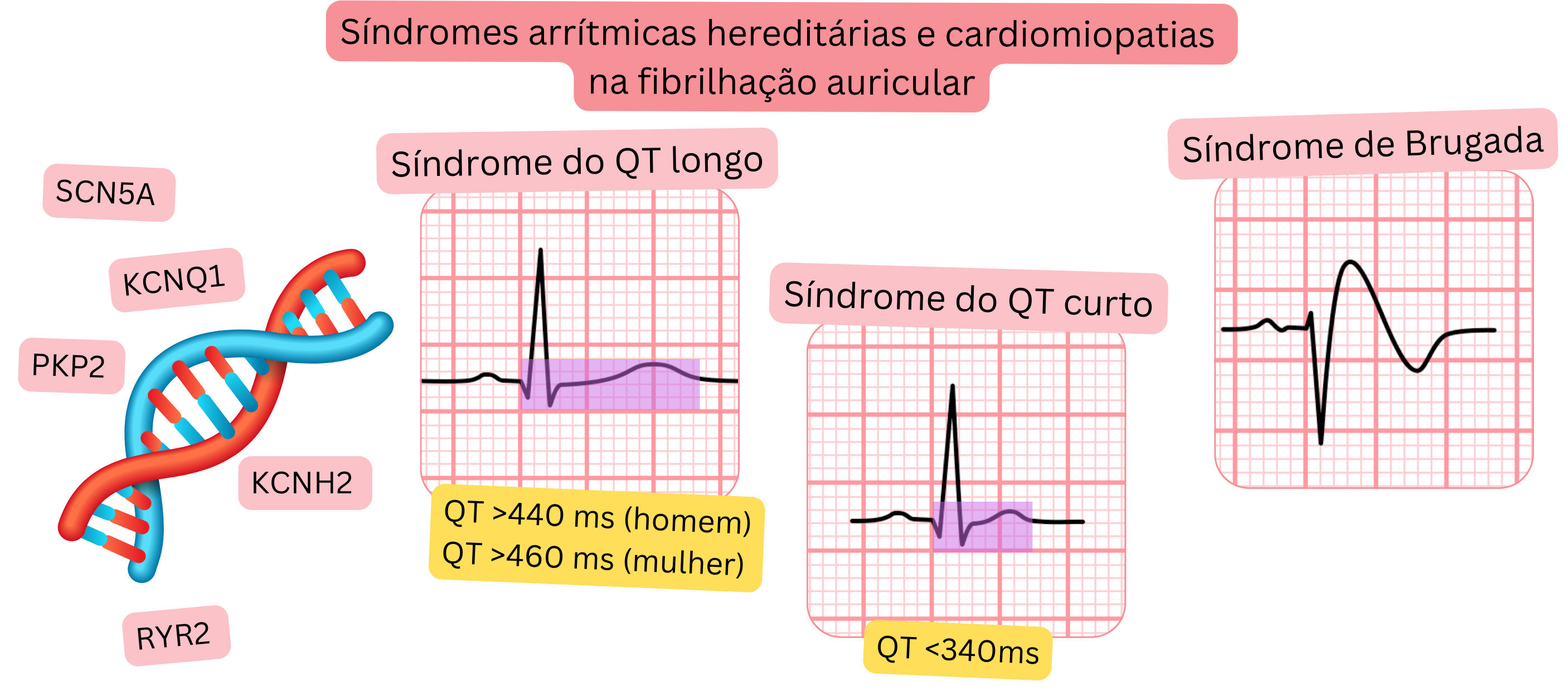 Visão geral das síndromes arrítmicas hereditárias e das cardiomiopatias associadas à fibrilação atrial, incluindo síndrome do QT longo, síndrome do QT curto e síndrome de Brugada, com achados típicos no ECG e mutações genéticas.
