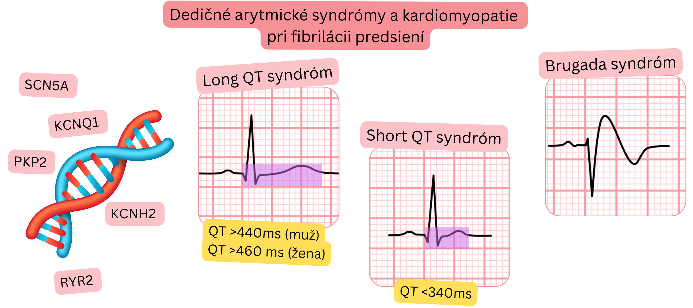 Prehľad dedičných arytmických syndrómov a kardiomyopatií asociovaných s fibriláciou predsiení vrátane long QT syndrómu, short QT syndrómu a Brugada syndrómu s typickými EKG znakmi a genetickými mutáciami.