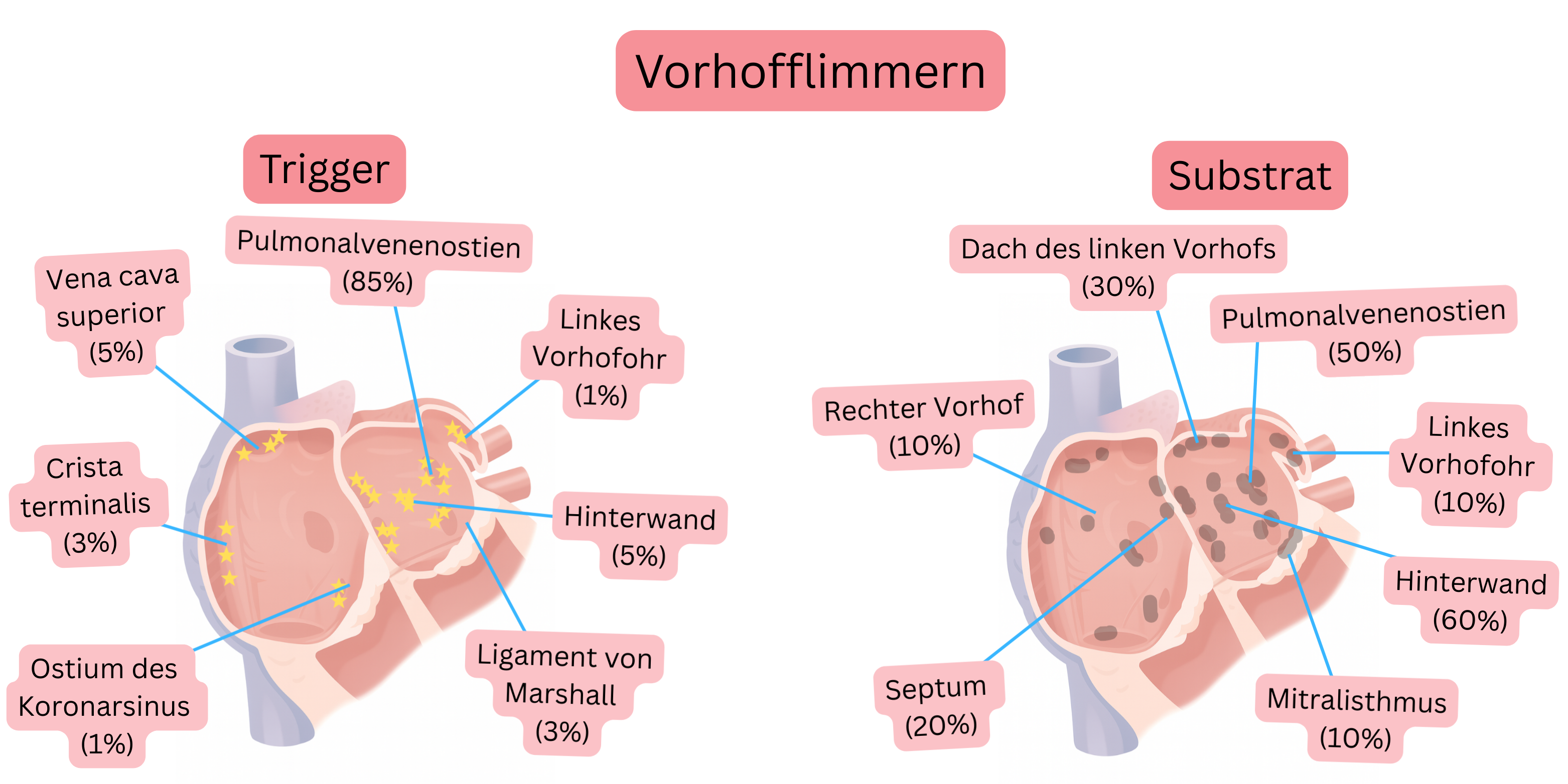 Schema des Vorhofflimmerns mit Darstellung von Triggerherden und atrialem Substrat, einschließlich der Ostien der Lungenvenen, der posterioren Wand und weiterer anatomischer Areale.