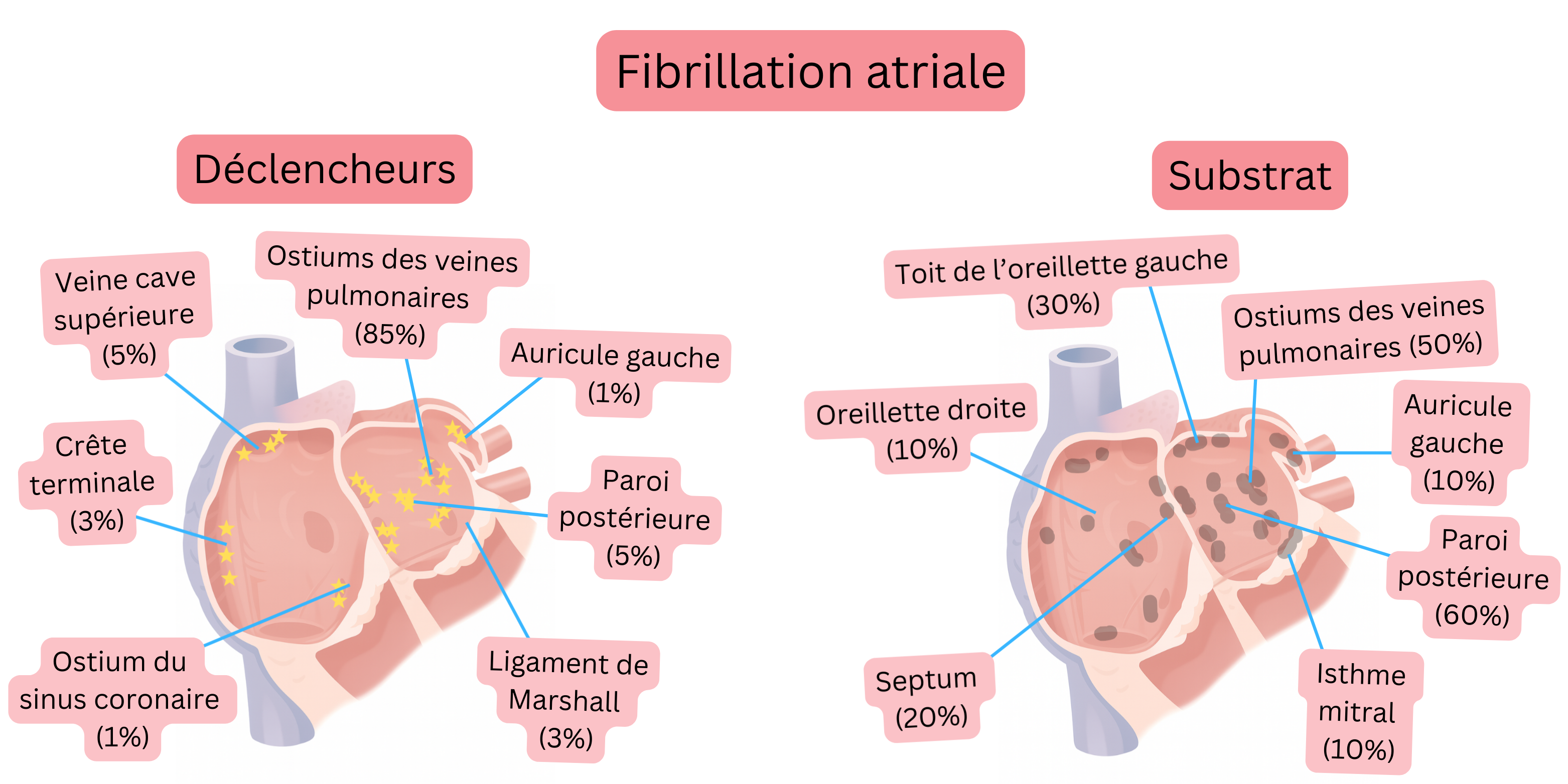 Schéma de la fibrillation atriale illustrant les foyers déclencheurs et le substrat auriculaire, incluant les ostiums des veines pulmonaires, la paroi postérieure et d’autres régions anatomiques.