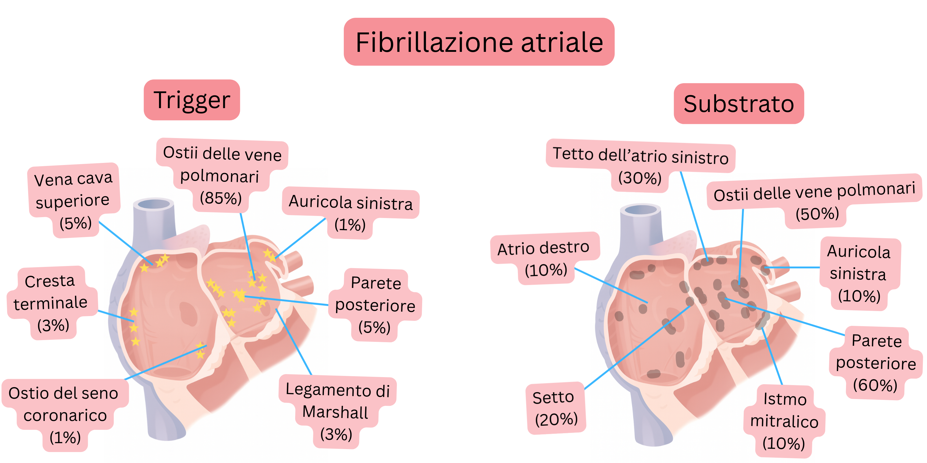 Schema della fibrillazione atriale che illustra i siti di innesco e il substrato atriale, includendo gli osti delle vene polmonari, la parete posteriore e altre regioni anatomiche.