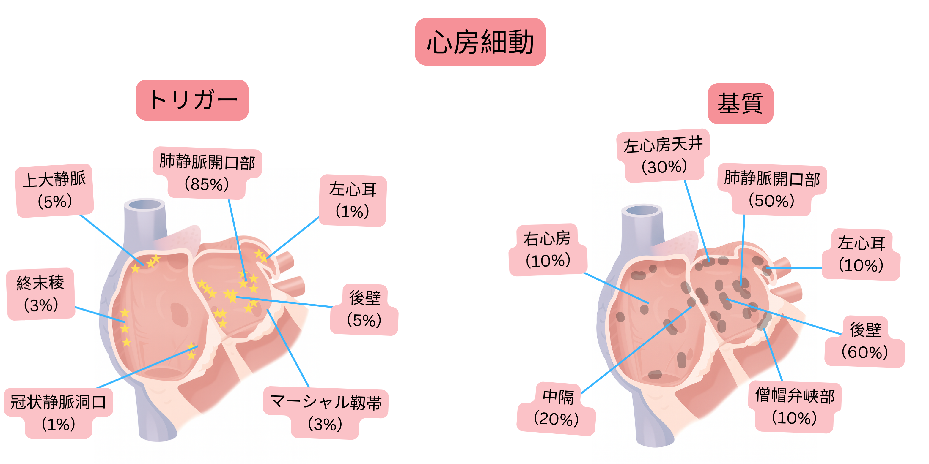 心房細動の模式図で、肺静脈開口部、後壁、その他の解剖学的領域を含むトリガー部位と心房基質を示す。