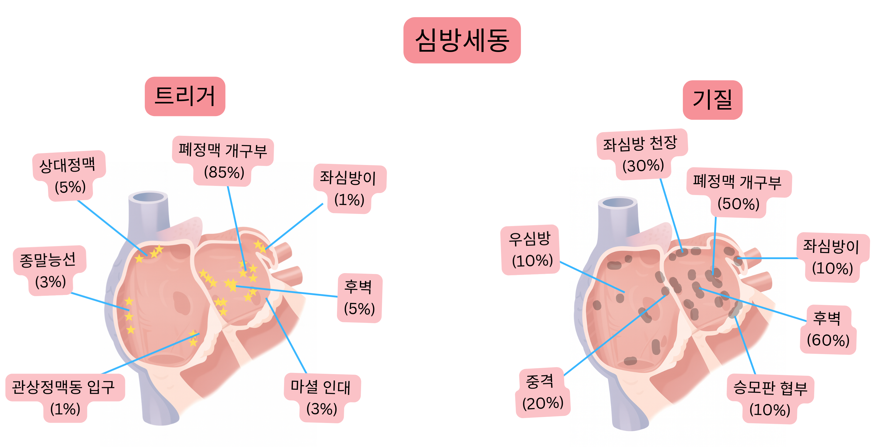 폐정맥 개구부, 후벽 및 기타 해부학적 부위를 포함한 유발 병소와 심방 기질을 보여주는 심방세동 도식.