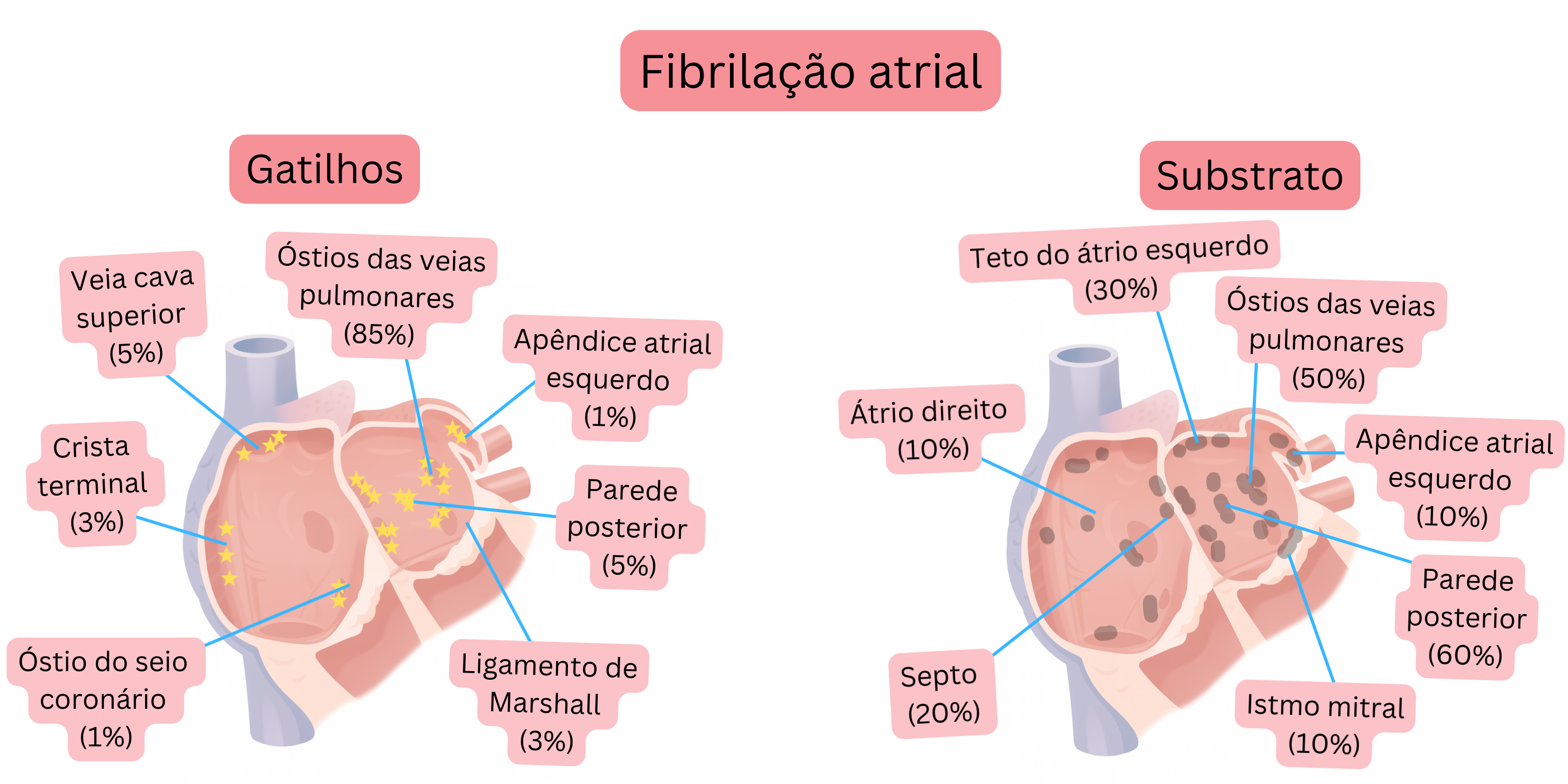 Esquema da fibrilação atrial ilustrando os focos desencadeantes e o substrato atrial, incluindo os óstios das veias pulmonares, a parede posterior e outras regiões anatômicas.