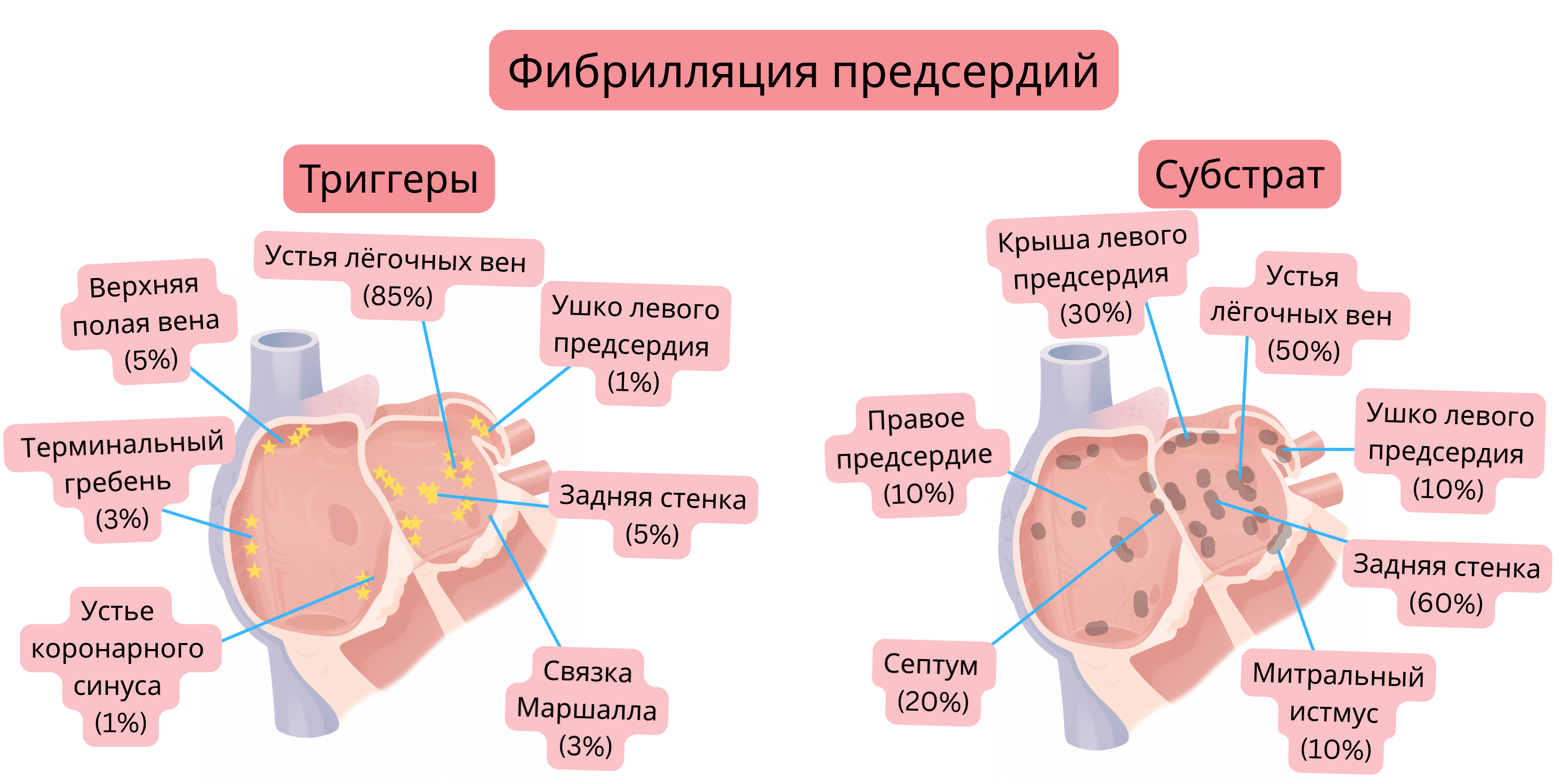 Схема фибрилляции предсердий, демонстрирующая триггерные очаги и предсердный субстрат, включая устья лёгочных вен, заднюю стенку и другие анатомические области.
