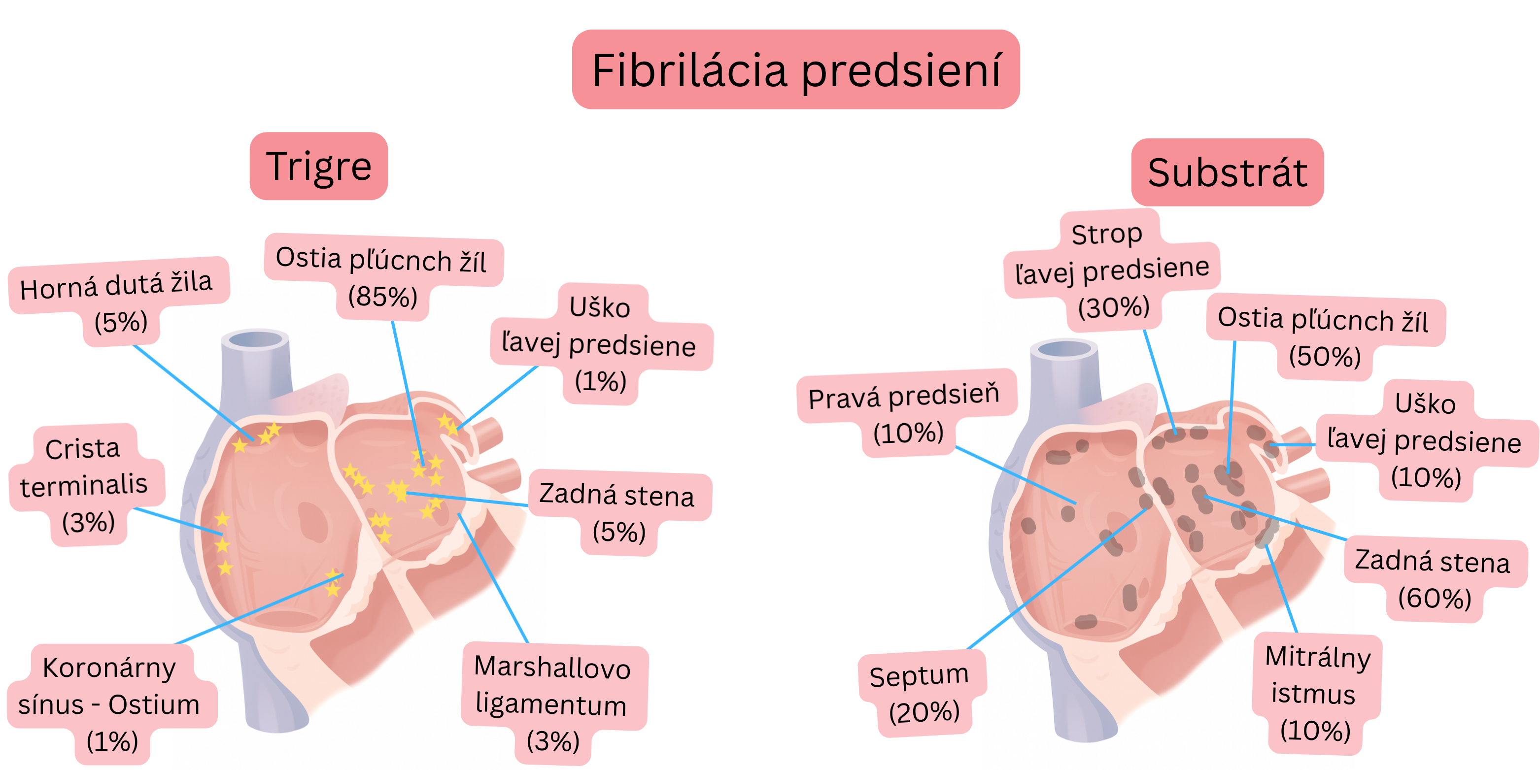 Schéma fibrilácie predsiení znázorňujúca spúšťacie ložiská a predsieňový substrát vrátane ostií pľúcnych žíl, zadnej steny a ďalších anatomických oblastí.