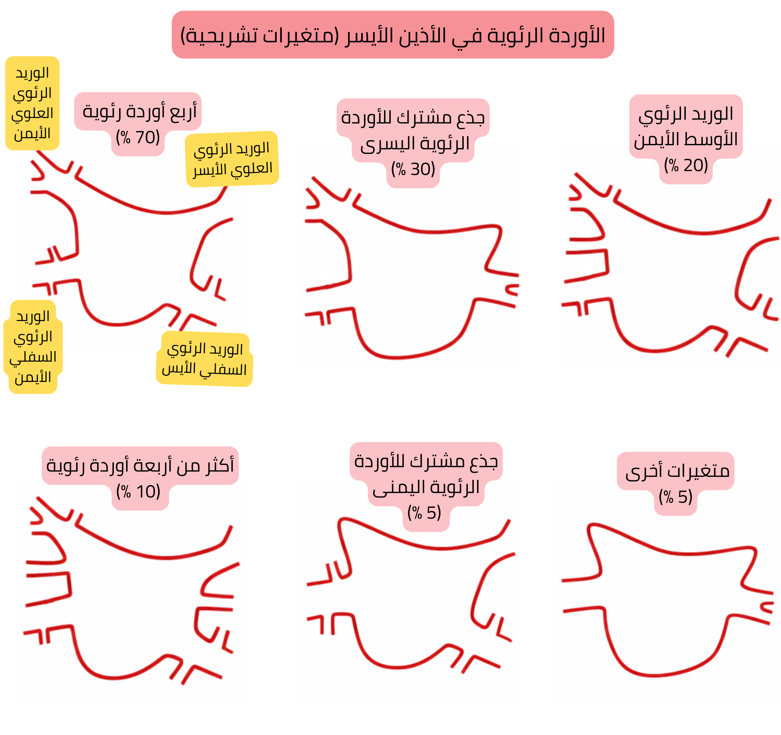 مخطط للمتغيرات التشريحية للأوردة الرئوية في الأذين الأيسر، بما في ذلك الجذع المشترك، والأوردة الرئوية الإضافية، ومتغيرات أخرى ذات صلة بالرجفان الأذيني.