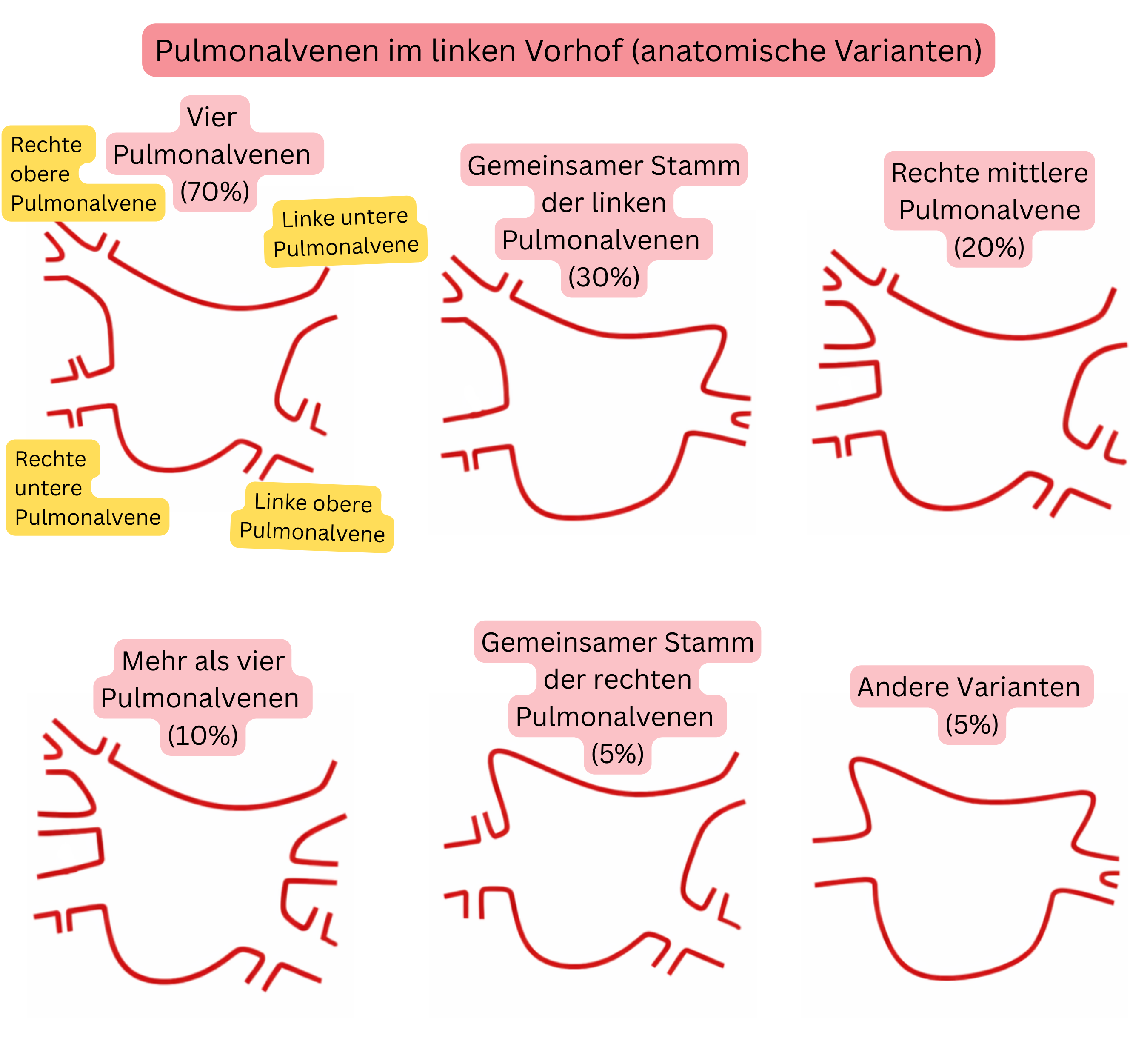 Schema anatomischer Varianten der Lungenvenen im linken Vorhof, einschließlich gemeinsamen Stamms, akzessorischer Lungenvenen und weiterer für Vorhofflimmern relevanter Varianten.