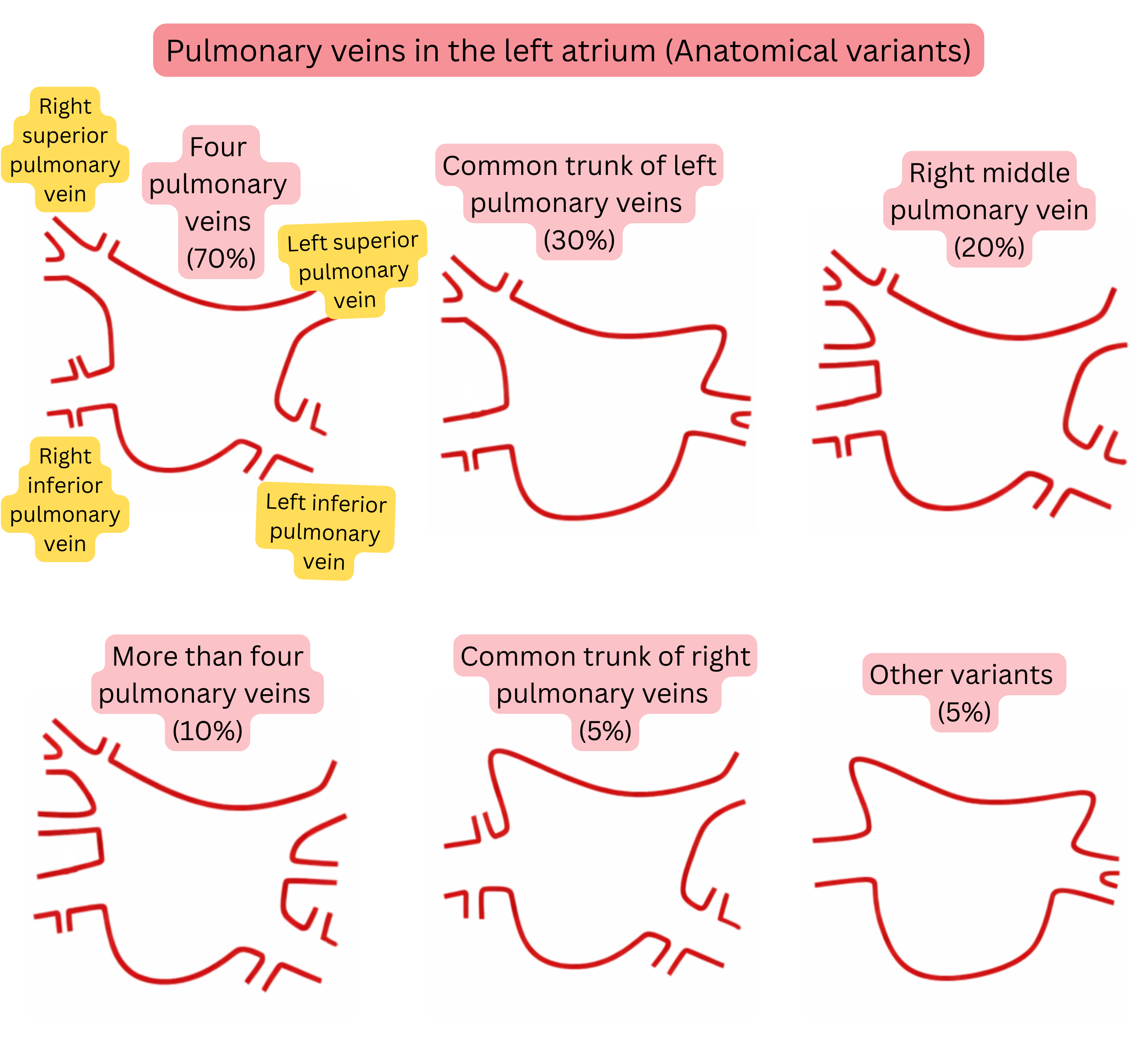 Diagram of anatomical variants of pulmonary veins in the left atrium, including a common trunk, accessory pulmonary veins, and other variants relevant to atrial fibrillation.