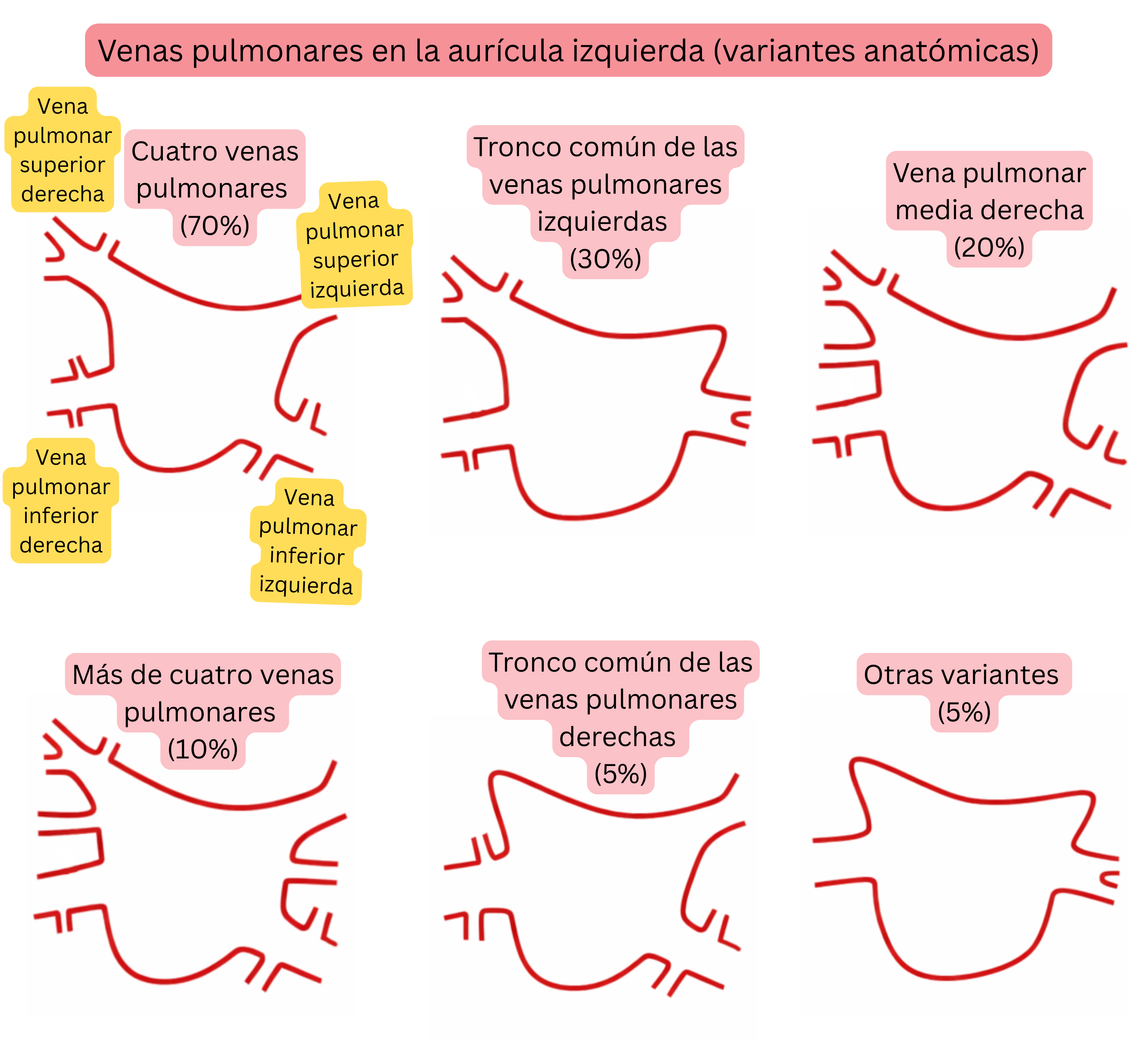 Esquema de las variantes anatómicas de las venas pulmonares en la aurícula izquierda, incluyendo tronco común, venas pulmonares accesorias y otras variantes relevantes para la fibrilación auricular.