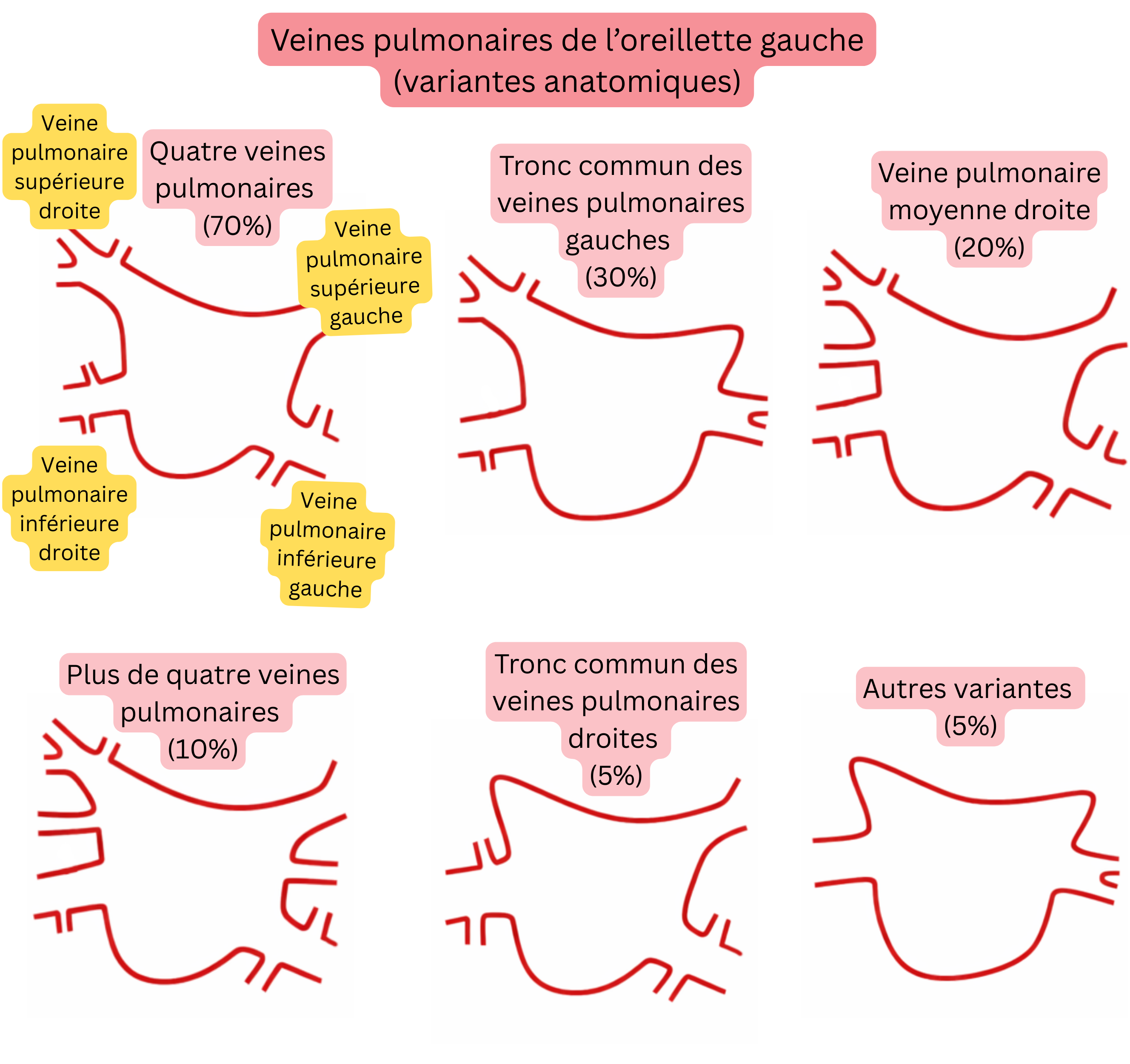 Schéma des variantes anatomiques des veines pulmonaires dans l’oreillette gauche, incluant un tronc commun, des veines pulmonaires accessoires et d’autres variantes pertinentes pour la fibrillation atriale.