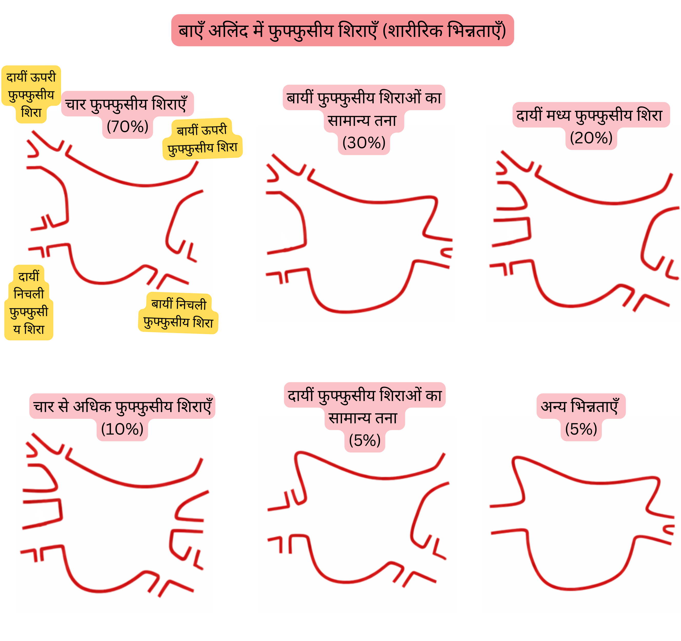 बाएँ एट्रियम में फुफ्फुसीय शिराओं के शारीरिक प्रकारों का आरेख, जिसमें कॉमन ट्रंक, अतिरिक्त फुफ्फुसीय शिराएँ और एट्रियल फिब्रिलेशन से संबंधित अन्य वैरिएंट शामिल हैं।