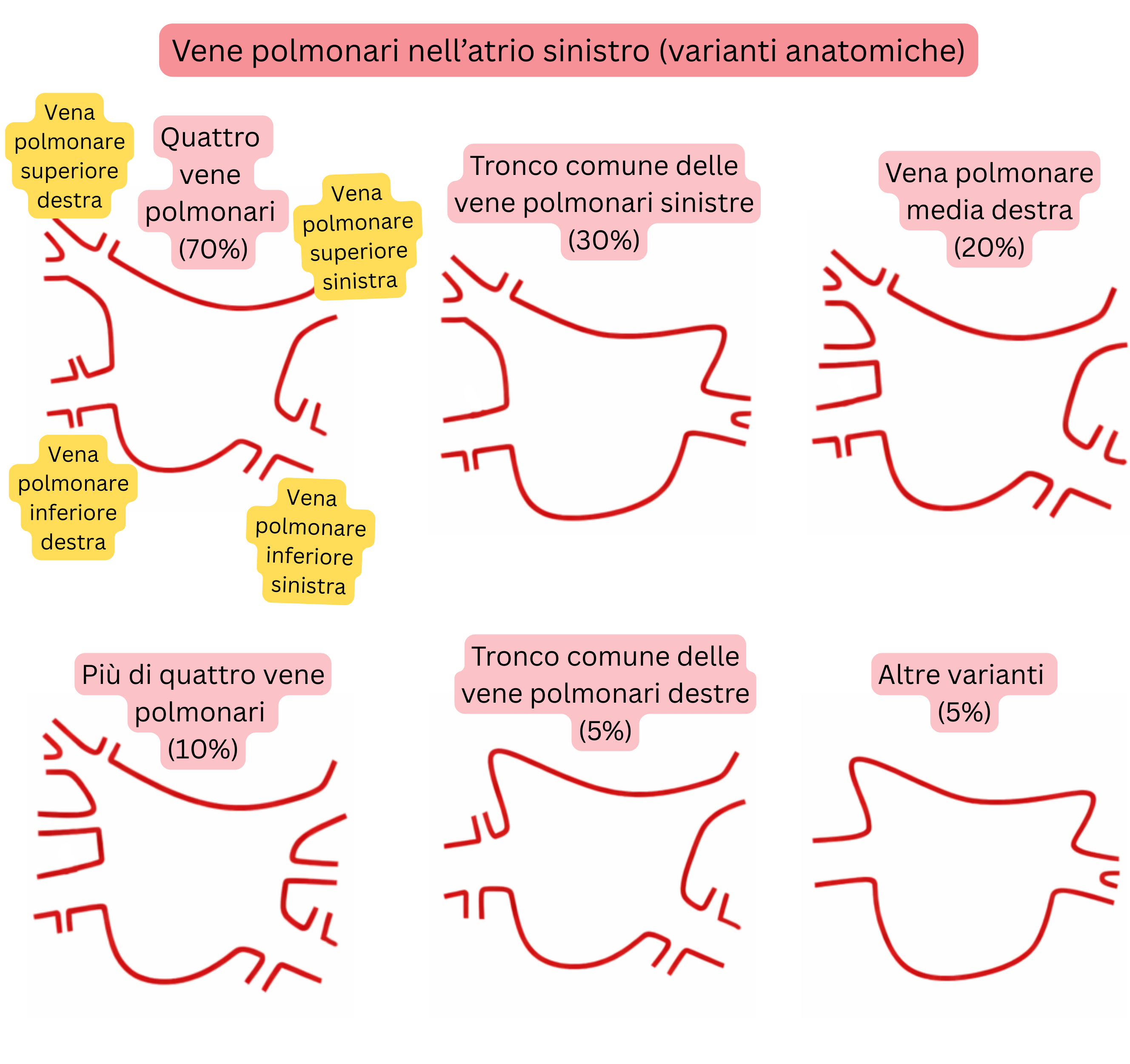 Schema delle varianti anatomiche delle vene polmonari nell’atrio sinistro, includendo tronco comune, vene polmonari accessorie e altre varianti rilevanti per la fibrillazione atriale.