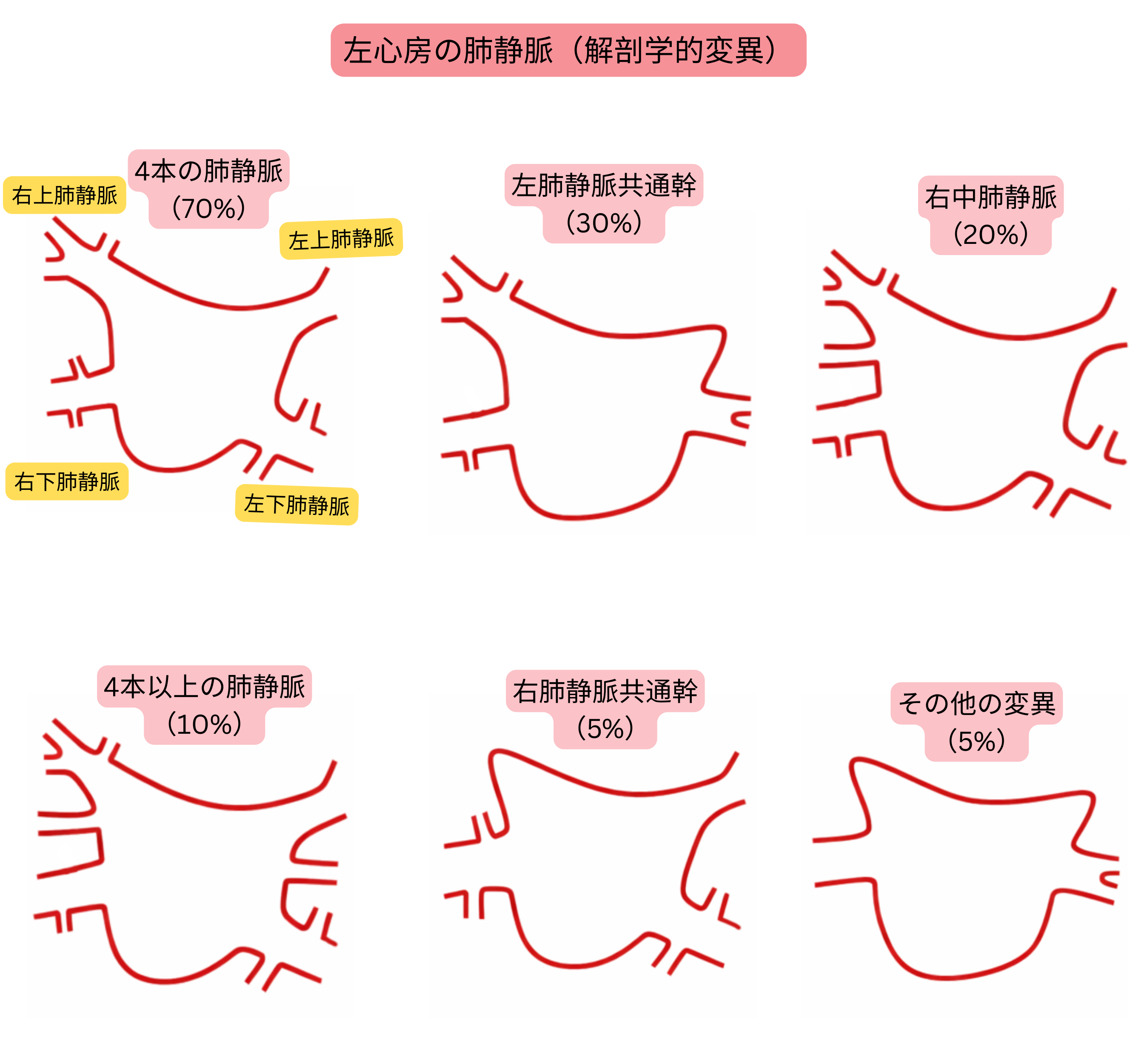左心房における肺静脈の解剖学的バリエーションを示す模式図で、共通幹、付加肺静脈、ならびに心房細動に関連するその他の変異を含む。