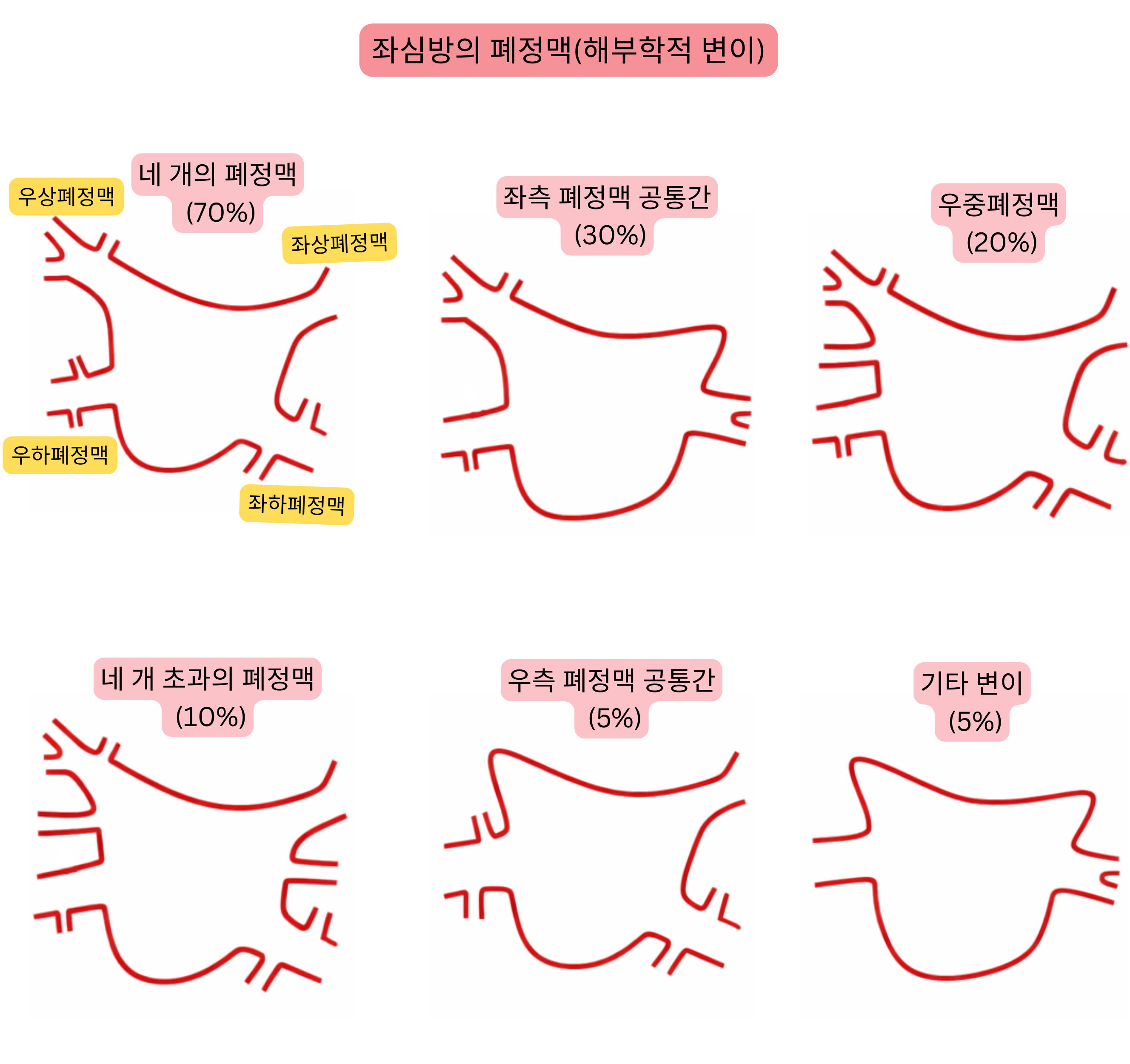 좌심방 내 폐정맥의 해부학적 변이를 보여주는 도식으로, 공통 줄기, 부가 폐정맥 및 심방세동과 관련된 기타 변이를 포함한다.