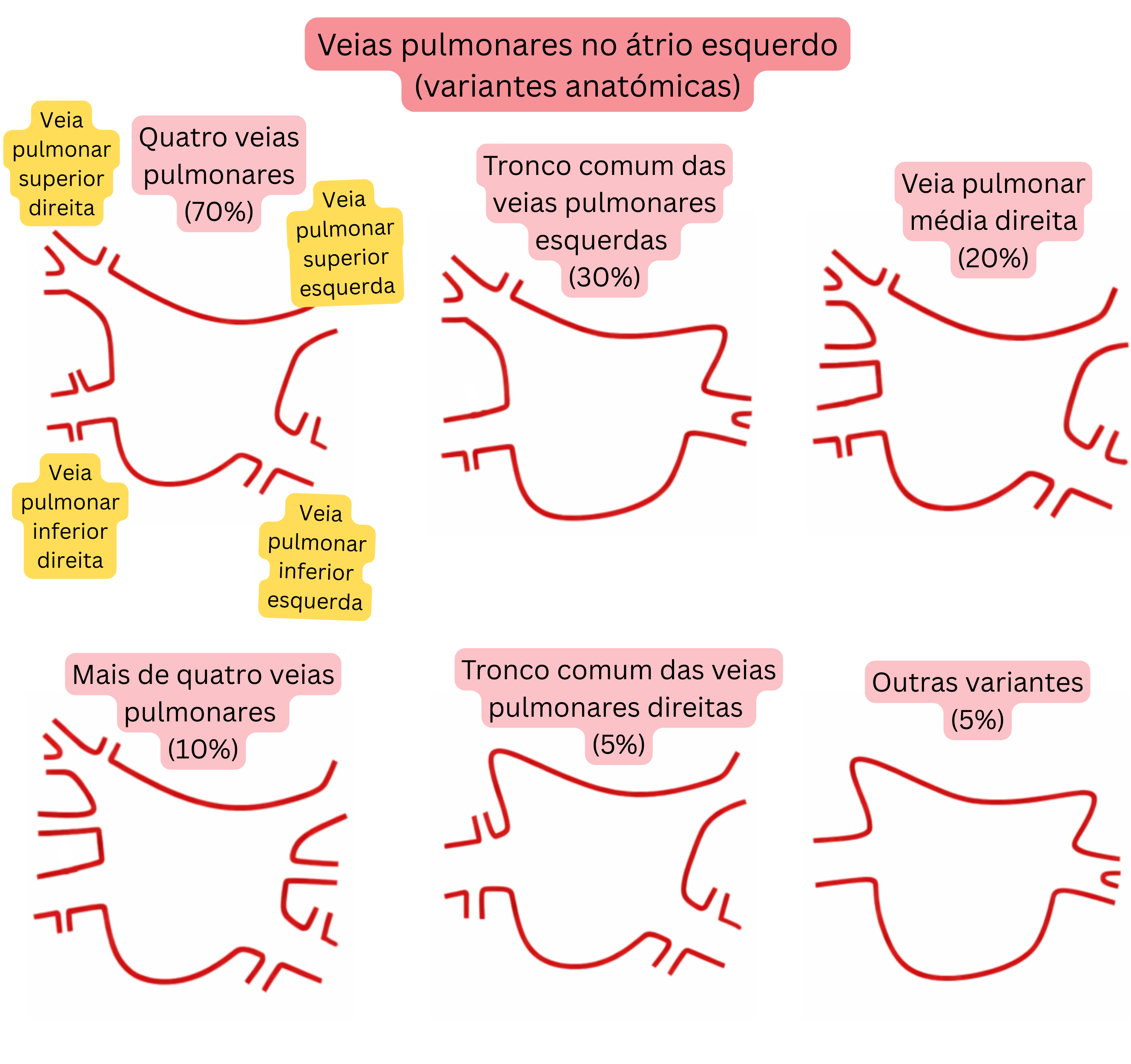 Esquema das variantes anatómicas das veias pulmonares no átrio esquerdo, incluindo tronco comum, veias pulmonares acessórias e outras variantes relevantes para a fibrilação atrial.