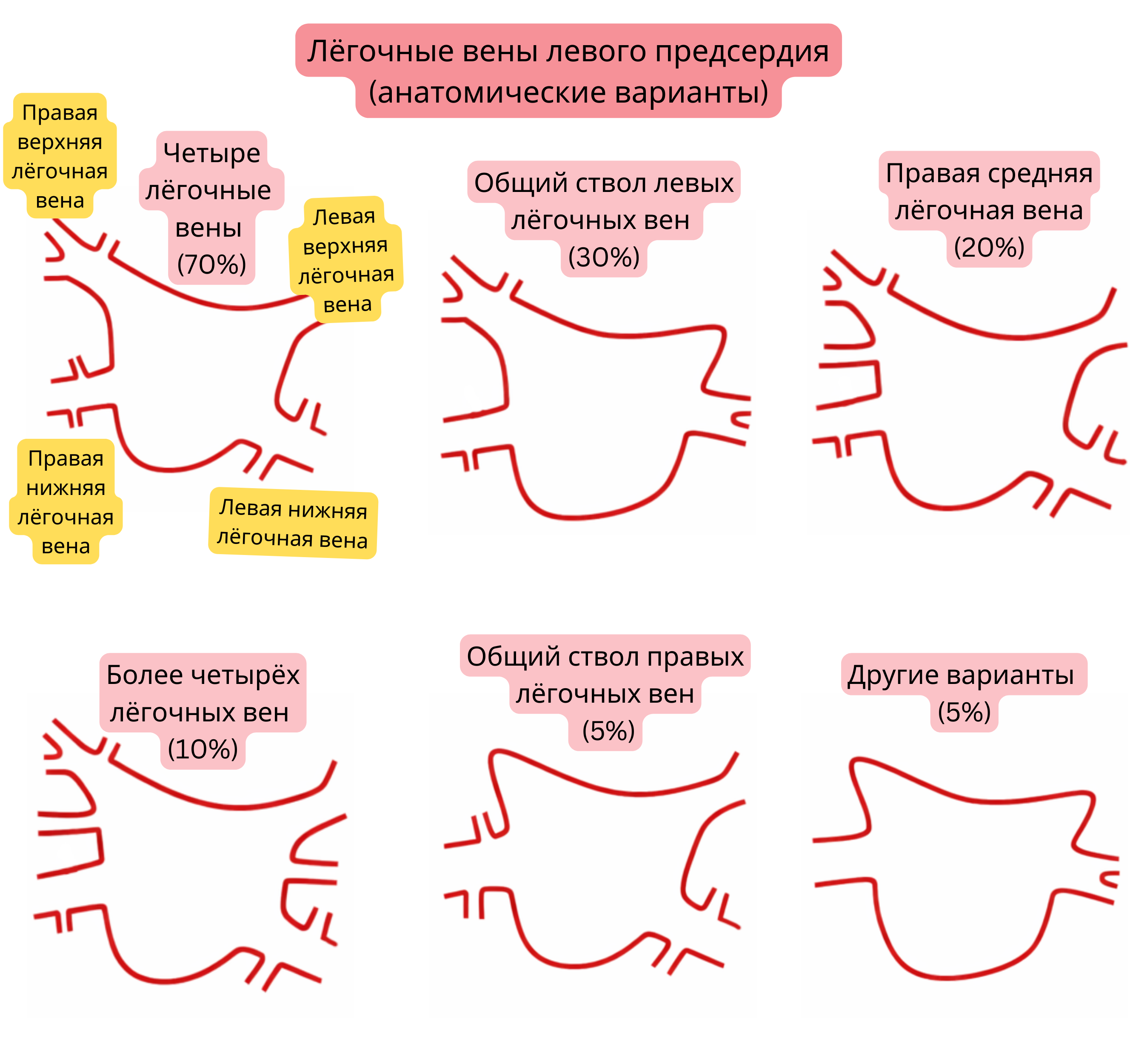 Схема анатомических вариантов лёгочных вен в левом предсердии, включая общий ствол, добавочные лёгочные вены и другие варианты, значимые для фибрилляции предсердий.
