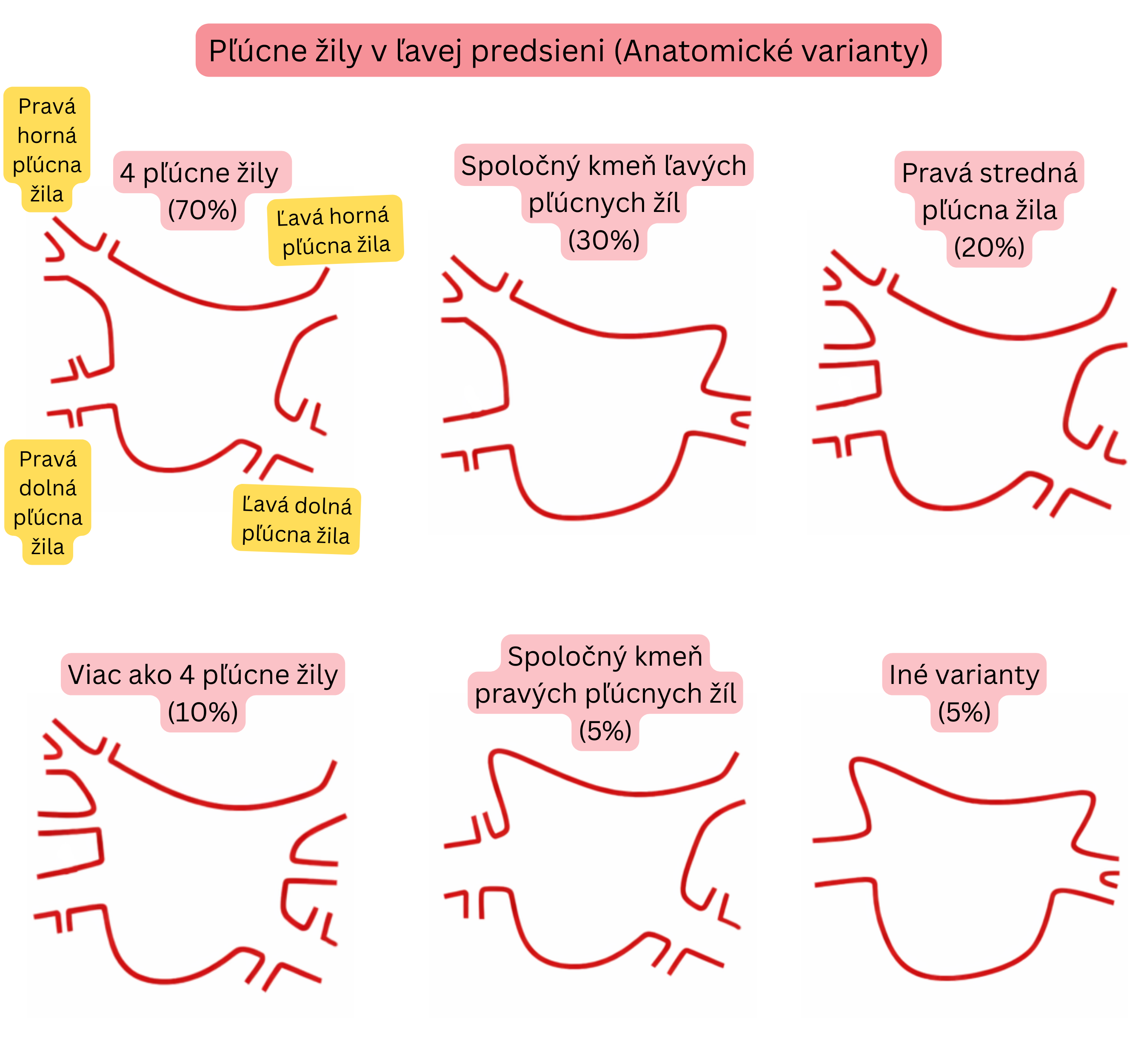 Schéma anatomických variantov pľúcnych žíl v ľavej predsieni vrátane spoločného kmeňa, nadpočetných pľúcnych žíl a ďalších variánt relevantných pre fibriláciu predsiení.
