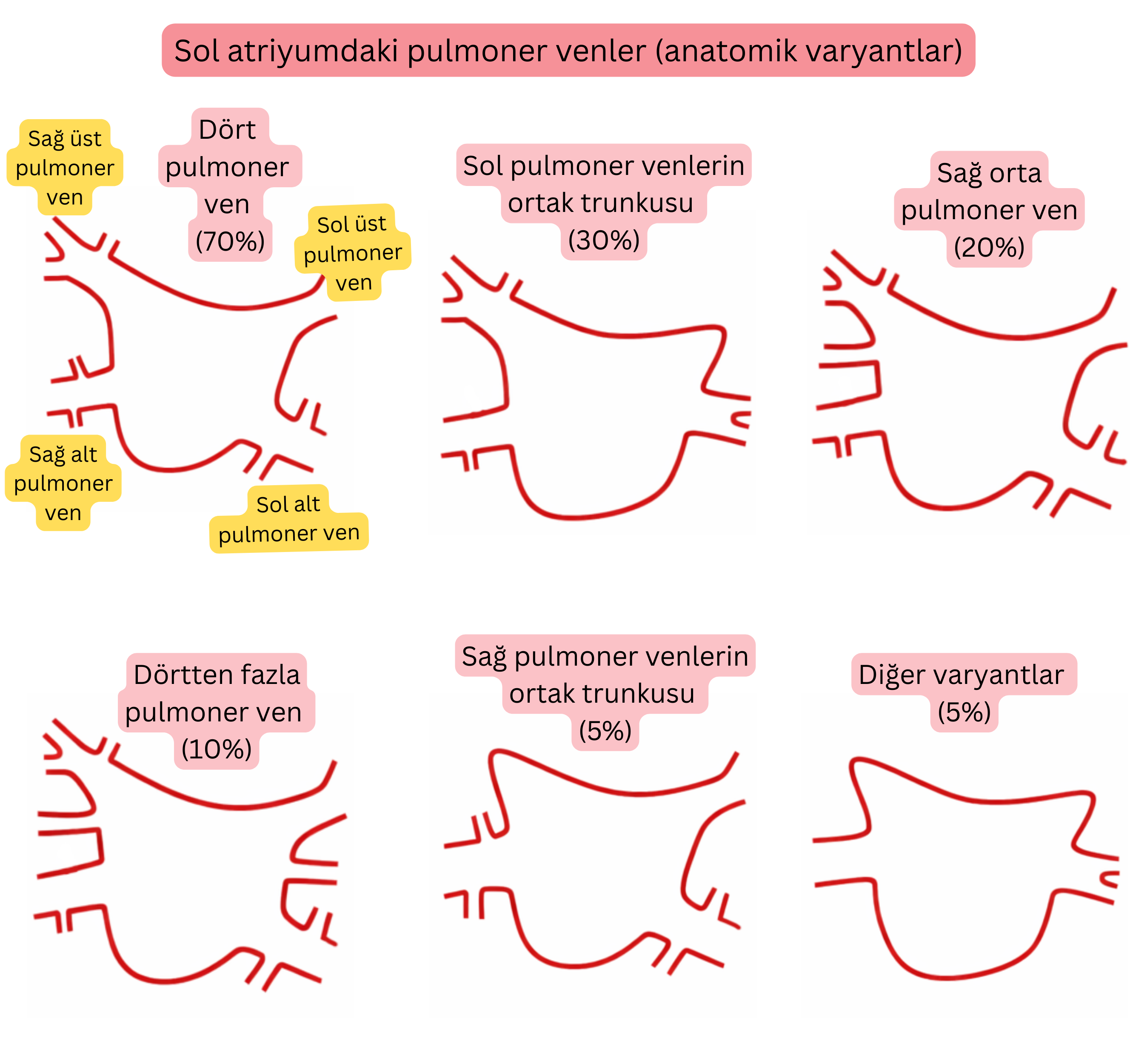 Sol atriyumda pulmoner venlerin anatomik varyantlarını gösteren şema; ortak trunkus, aksesuar pulmoner venler ve atriyal fibrilasyon açısından önemli diğer varyantları içermektedir.