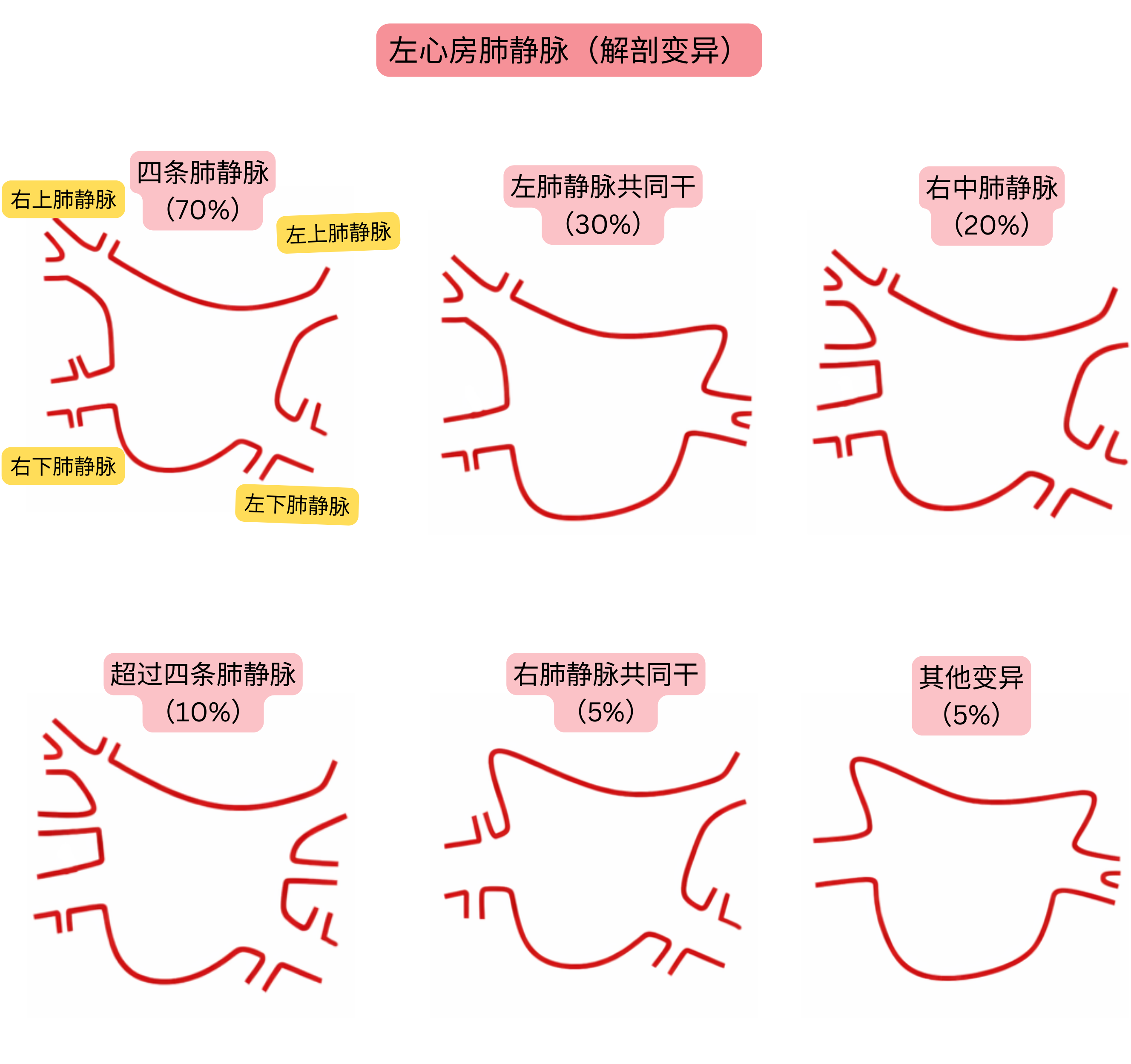 左心房肺静脉解剖变异示意图，包括共同干、附加肺静脉及其他与心房颤动相关的变异。
