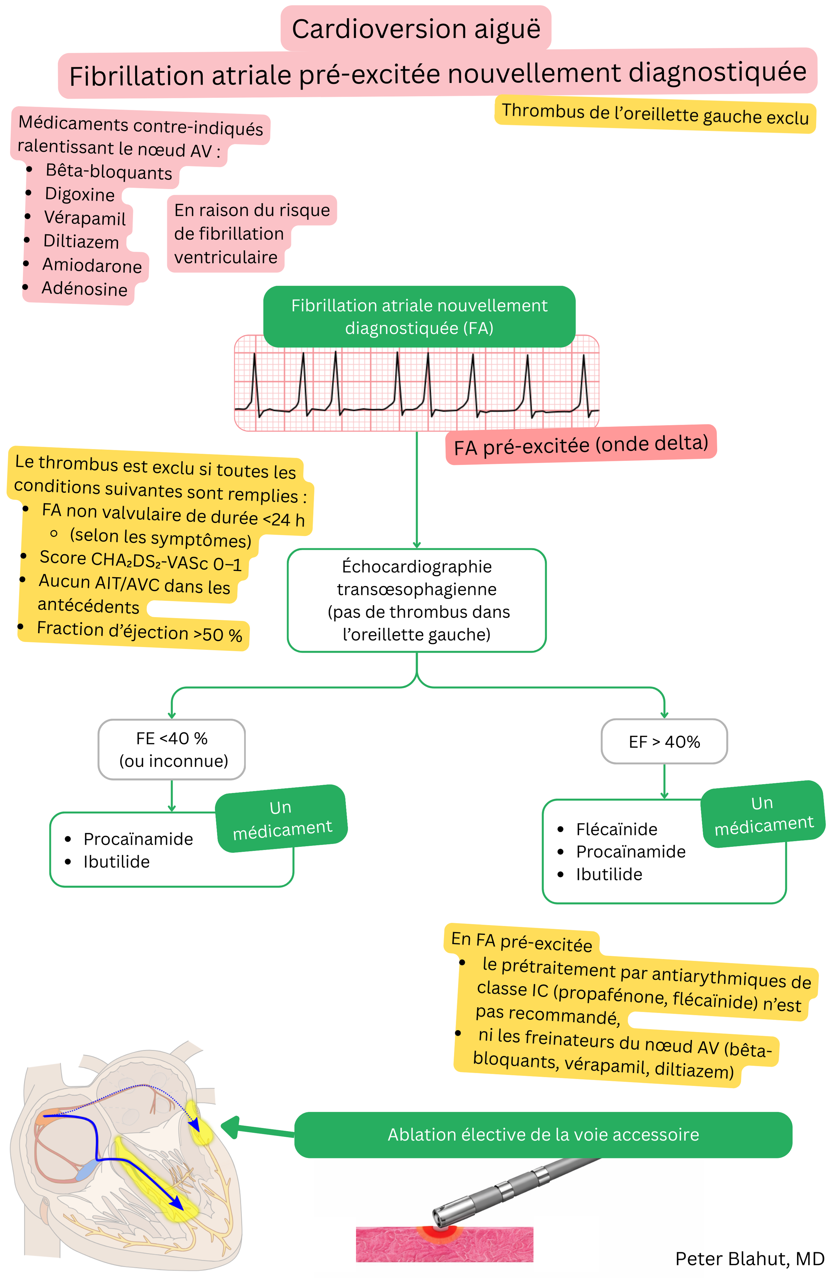 Algorithme de recommandations pour la cardioversion aiguë d’une fibrillation auriculaire préexcitée récemment diagnostiquée avec contre-indication des bloqueurs du nœud AV et choix des antiarythmiques selon la fraction d’éjection.