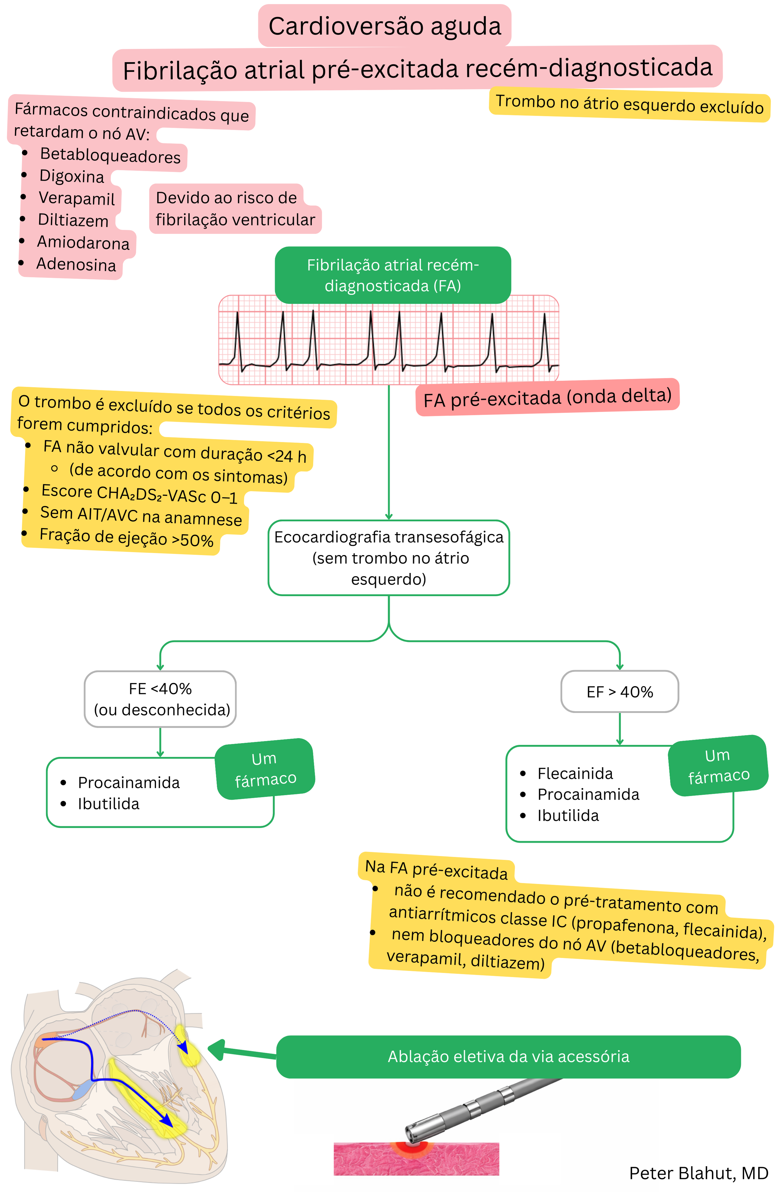 Algoritmo de recomendações para cardioversão aguda na fibrilação atrial pré-excitada recém-diagnosticada com contraindicação aos bloqueadores do nó AV e seleção de antiarrítmicos conforme a fração de ejeção.