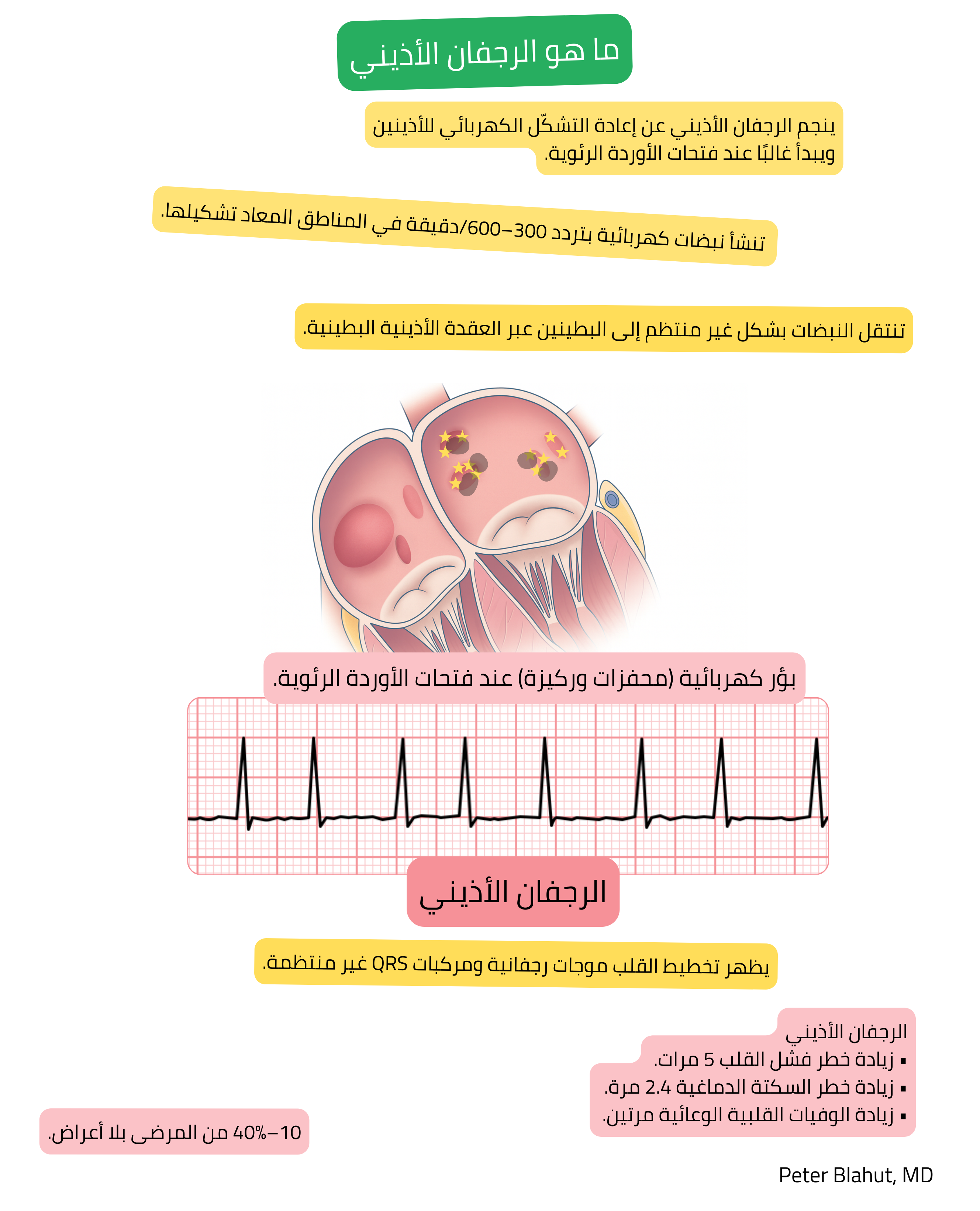 مخطط آلية الرجفان الأذيني مع بؤر كهربائية شاردة عند فتحات الأوردة الرئوية وتخطيط قلب يُظهر موجات رجفانية ومركبات QRS غير منتظمة.