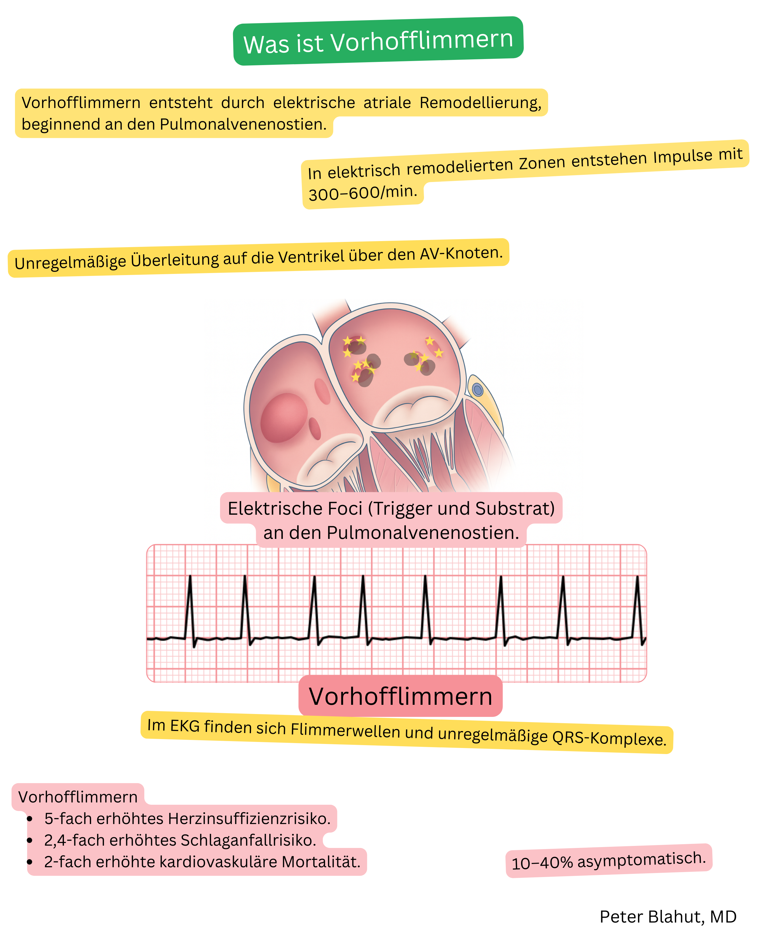 Schematische Darstellung des Mechanismus des Vorhofflimmerns mit ektopen elektrischen Foci an den Mündungen der Pulmonalvenen und EKG mit Flimmerwellen sowie unregelmäßigen QRS-Komplexen.