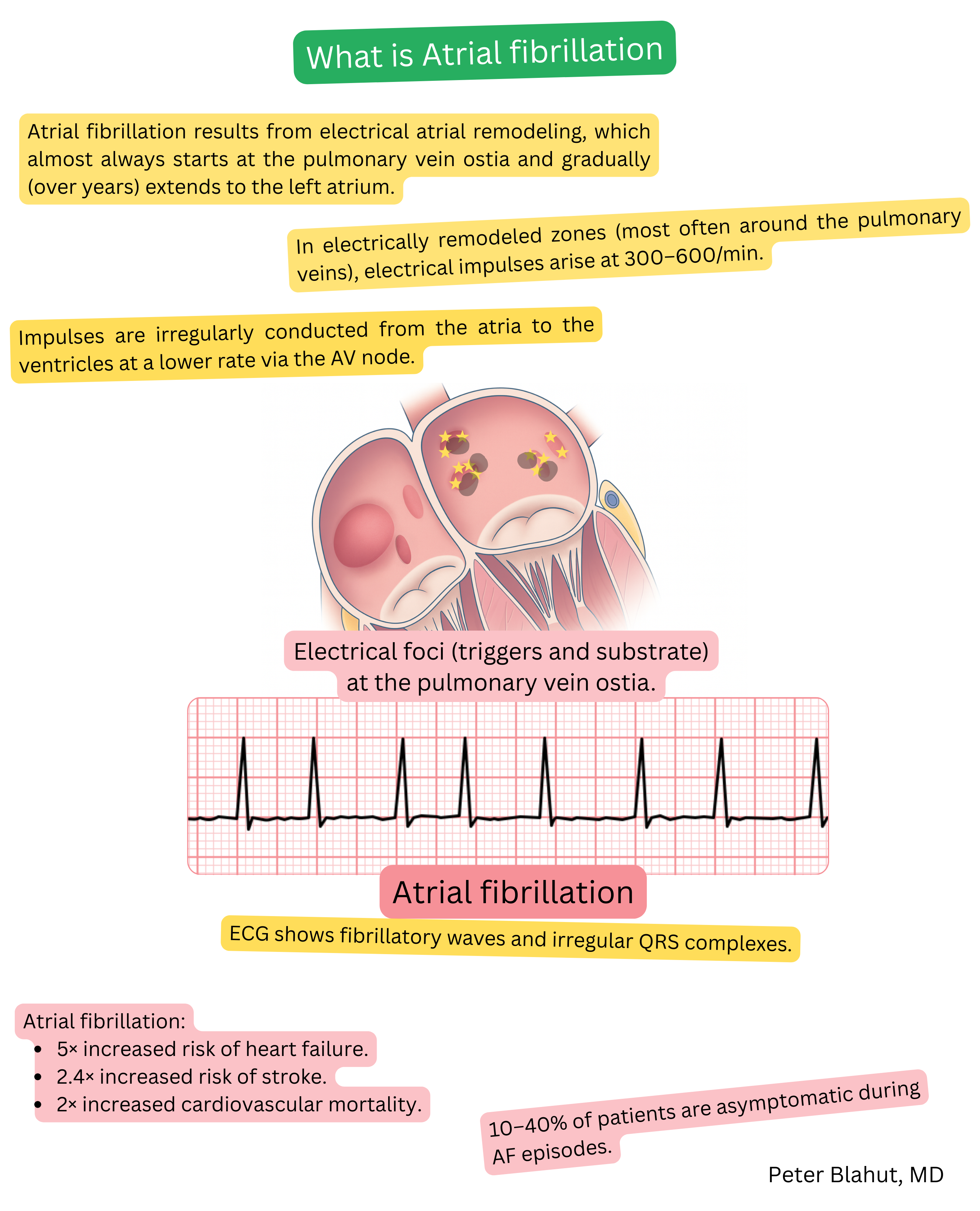 Diagram of the atrial fibrillation mechanism with ectopic electrical foci at the pulmonary vein ostia and ECG tracing showing fibrillatory waves with irregular QRS complexes.