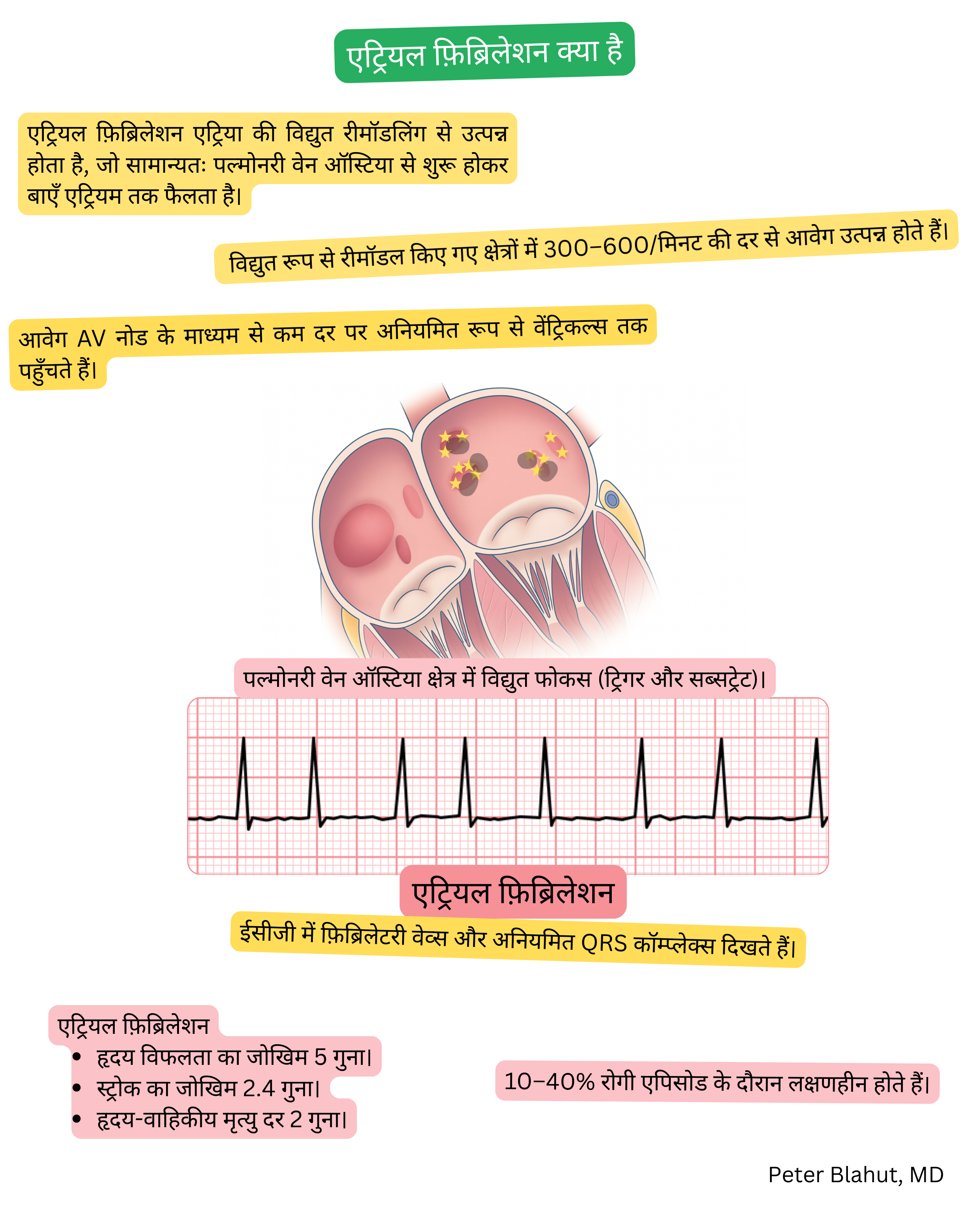 एट्रियल फिब्रिलेशन की रोगजनन प्रक्रिया का आरेख जिसमें पल्मोनरी वेन ओस्टिया में एक्टोपिक विद्युत फोकस तथा ईसीजी में फिब्रिलेटरी तरंगें और अनियमित QRS कॉम्प्लेक्स दर्शाए गए हैं।