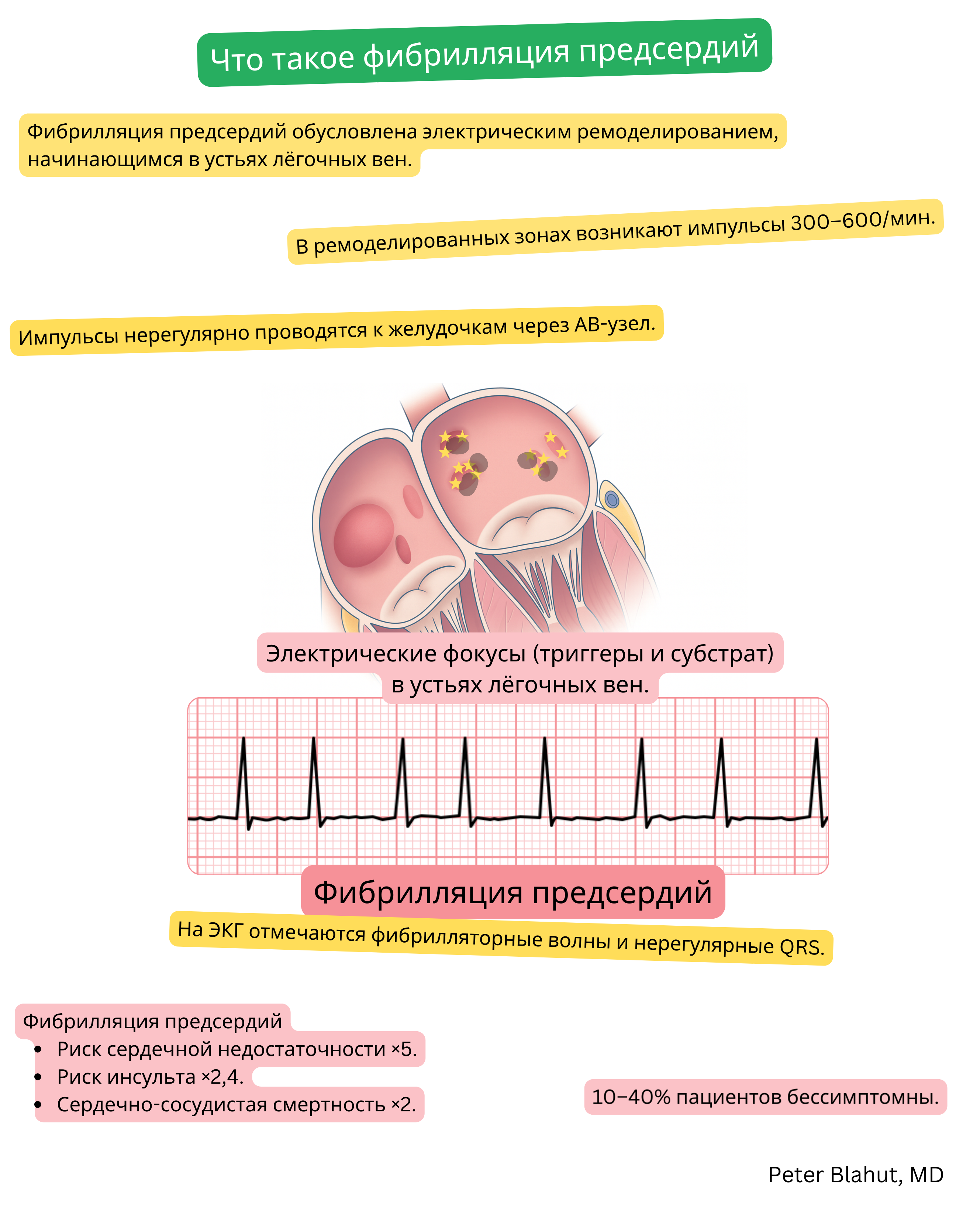 Схема механизма фибрилляции предсердий с эктопическими электрическими очагами в устьях легочных вен и ЭКГ с фибрилляторными волнами и нерегулярными комплексами QRS.