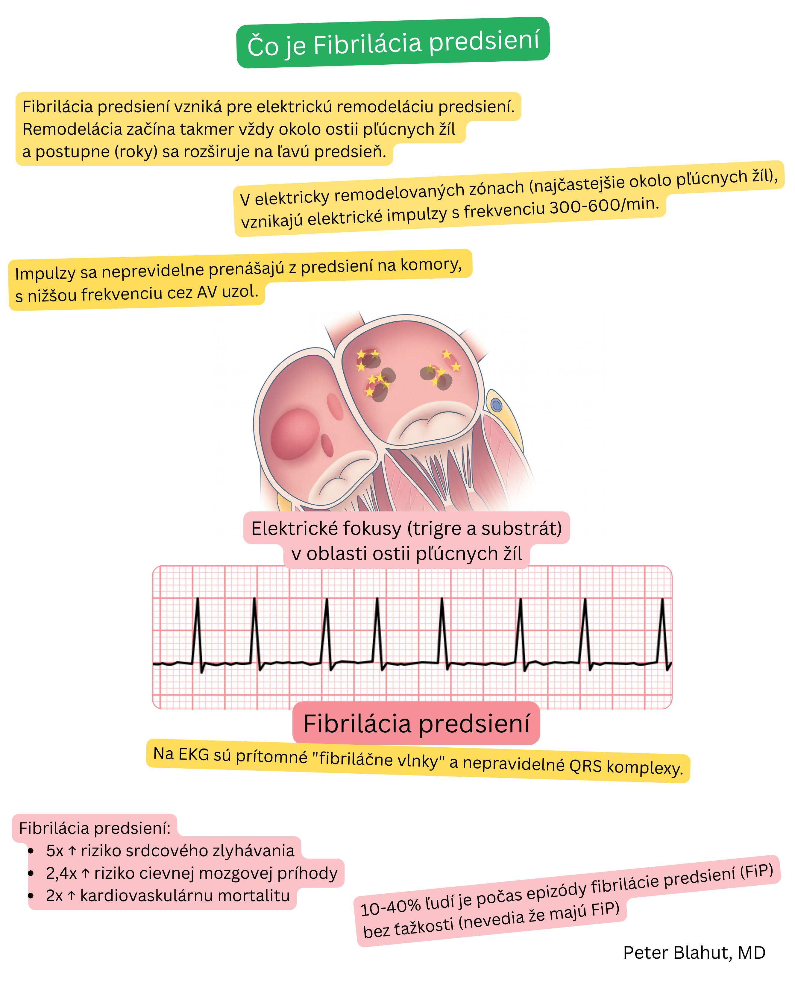 Schéma mechanizmu fibrilácie predsiení s elektrickými fokusmi v oblasti ústí pľúcnych žíl a EKG záznamom s fibrilačnými vlnami a nepravidelnými QRS komplexmi.
