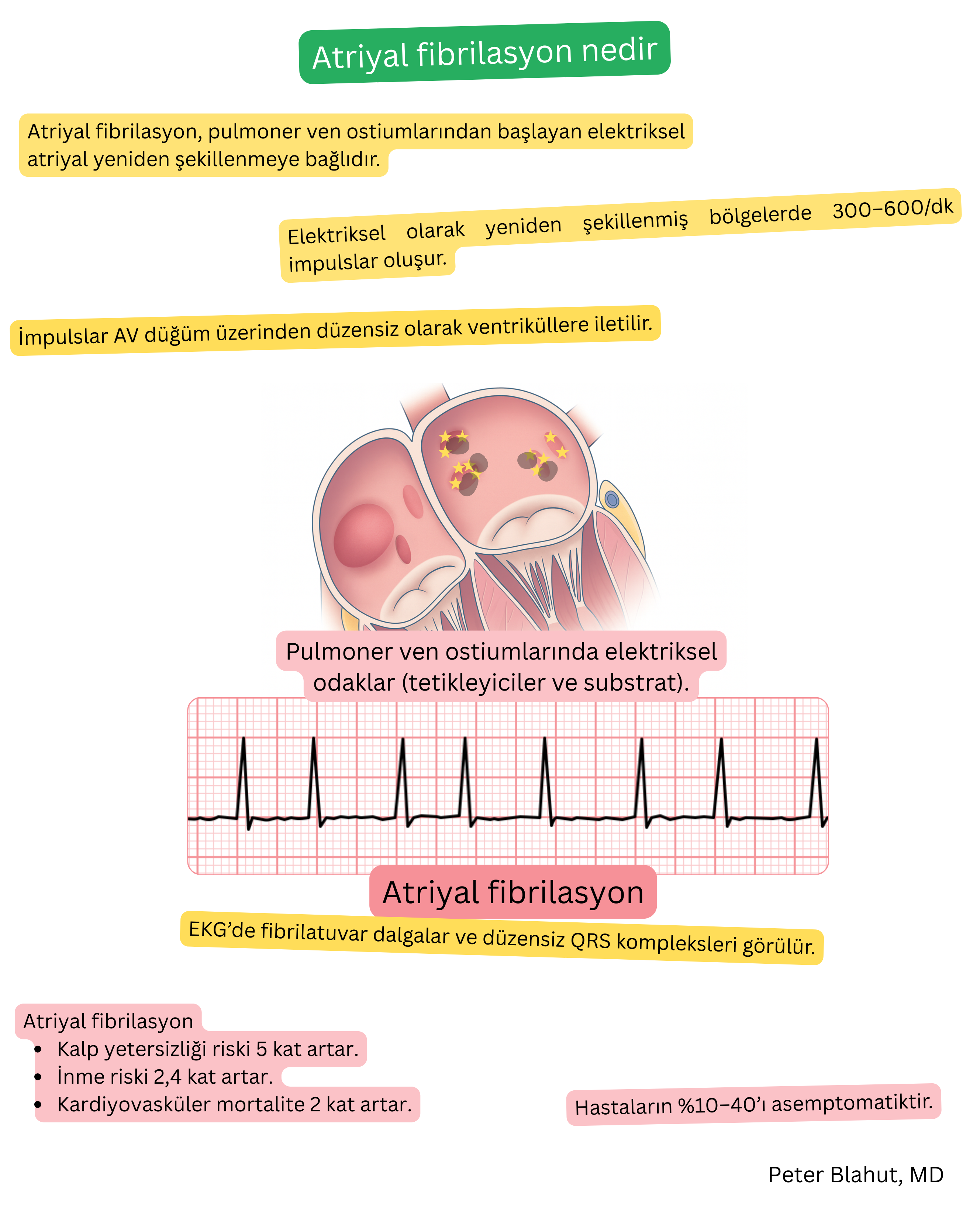 Pulmoner ven ostiumlarında ektopik elektrik odaklarını gösteren atriyal fibrilasyon mekanizması şeması ve fibrilatuar dalgalar ile düzensiz QRS kompleksleri içeren EKG kaydı.