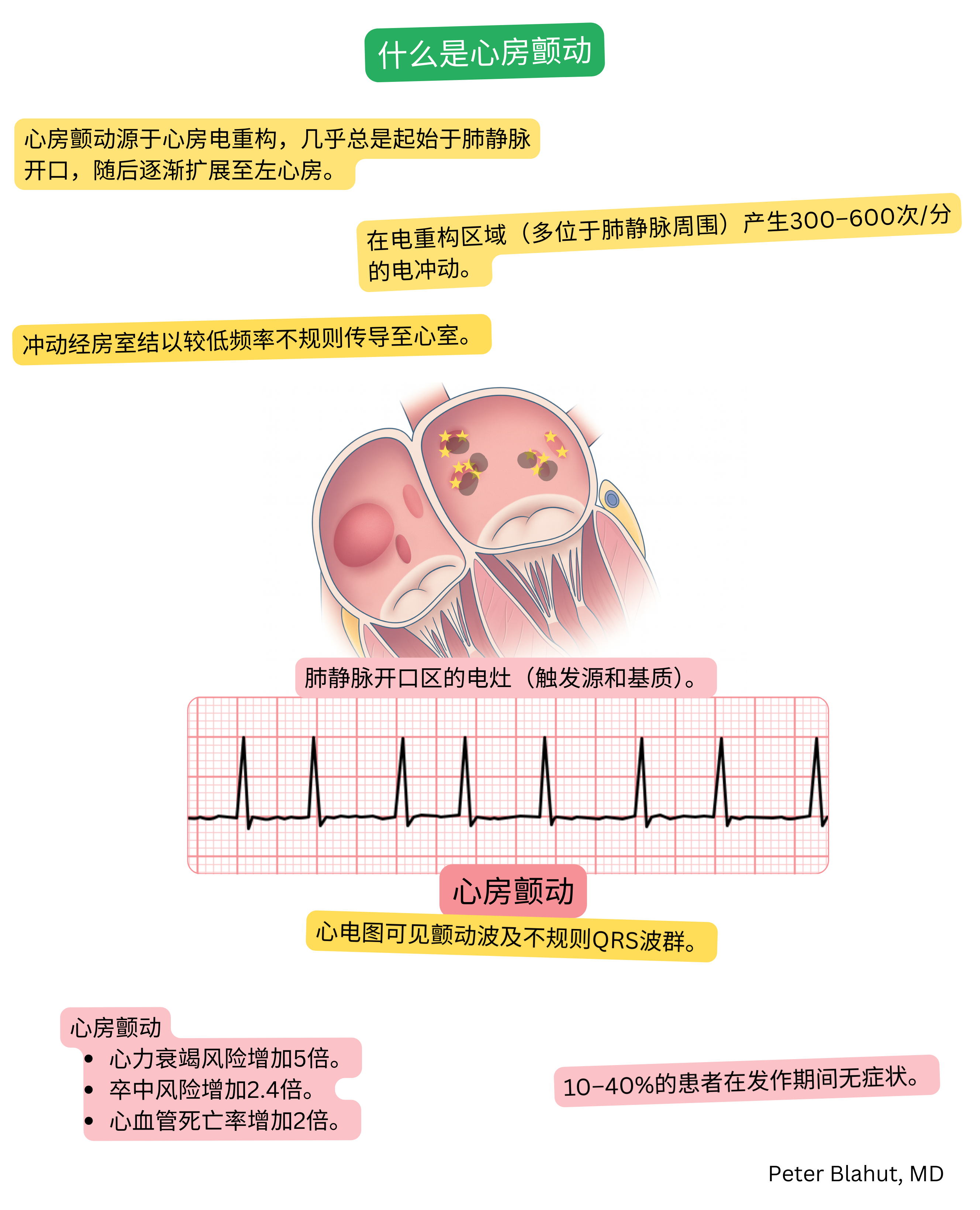 房颤机制示意图，显示肺静脉开口处的异位电活动灶及心电图中可见纤颤波和不规则QRS波群。