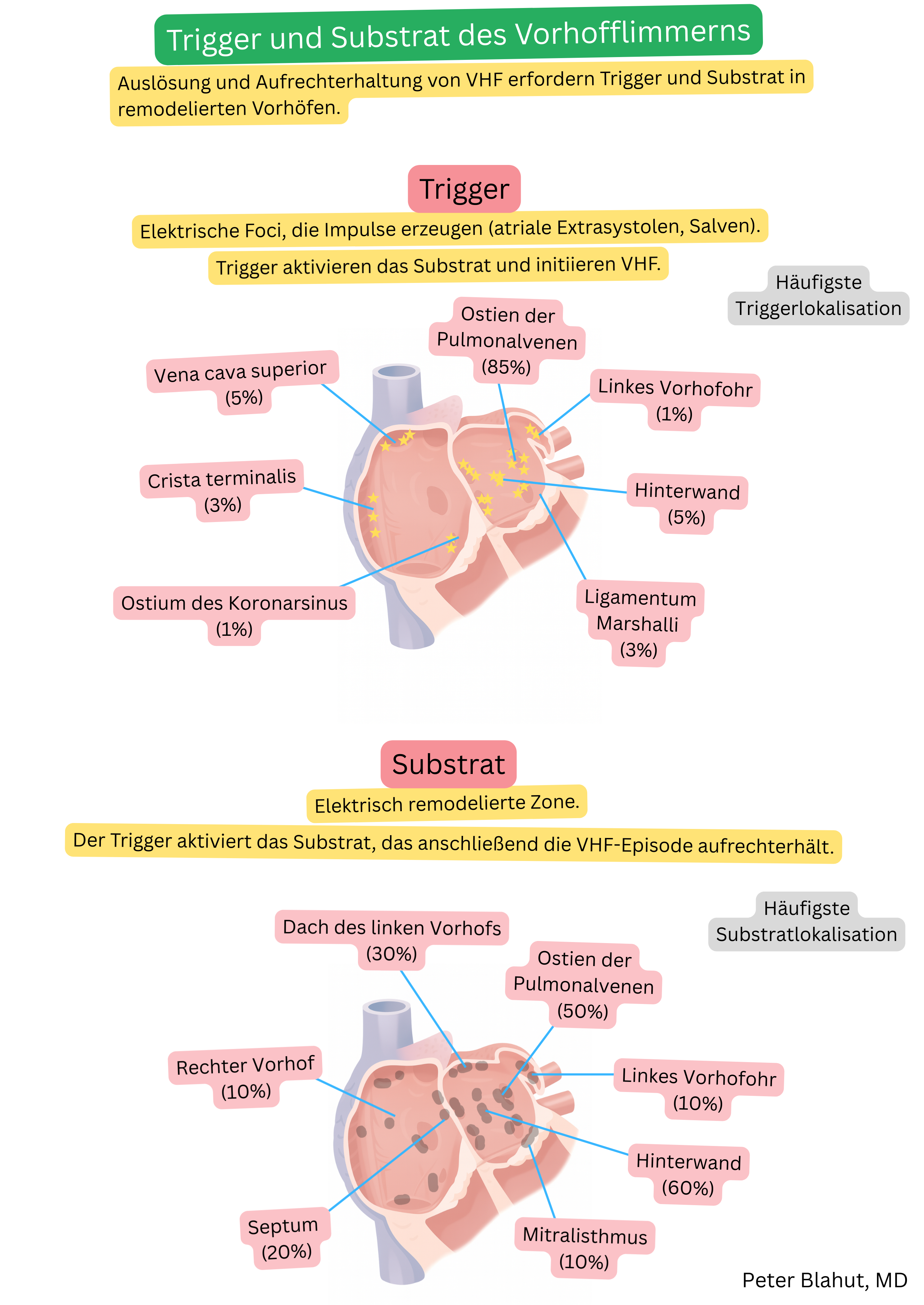 Schema zur Lokalisation von Triggern und arrhythmogenem Substrat des Vorhofflimmerns mit Hervorhebung der Pulmonalvenenostien, der posterioren Wand des linken Vorhofs und weiterer anatomischer Areale, die an Initiierung und Aufrechterhaltung der Arrhythmie beteiligt sind.