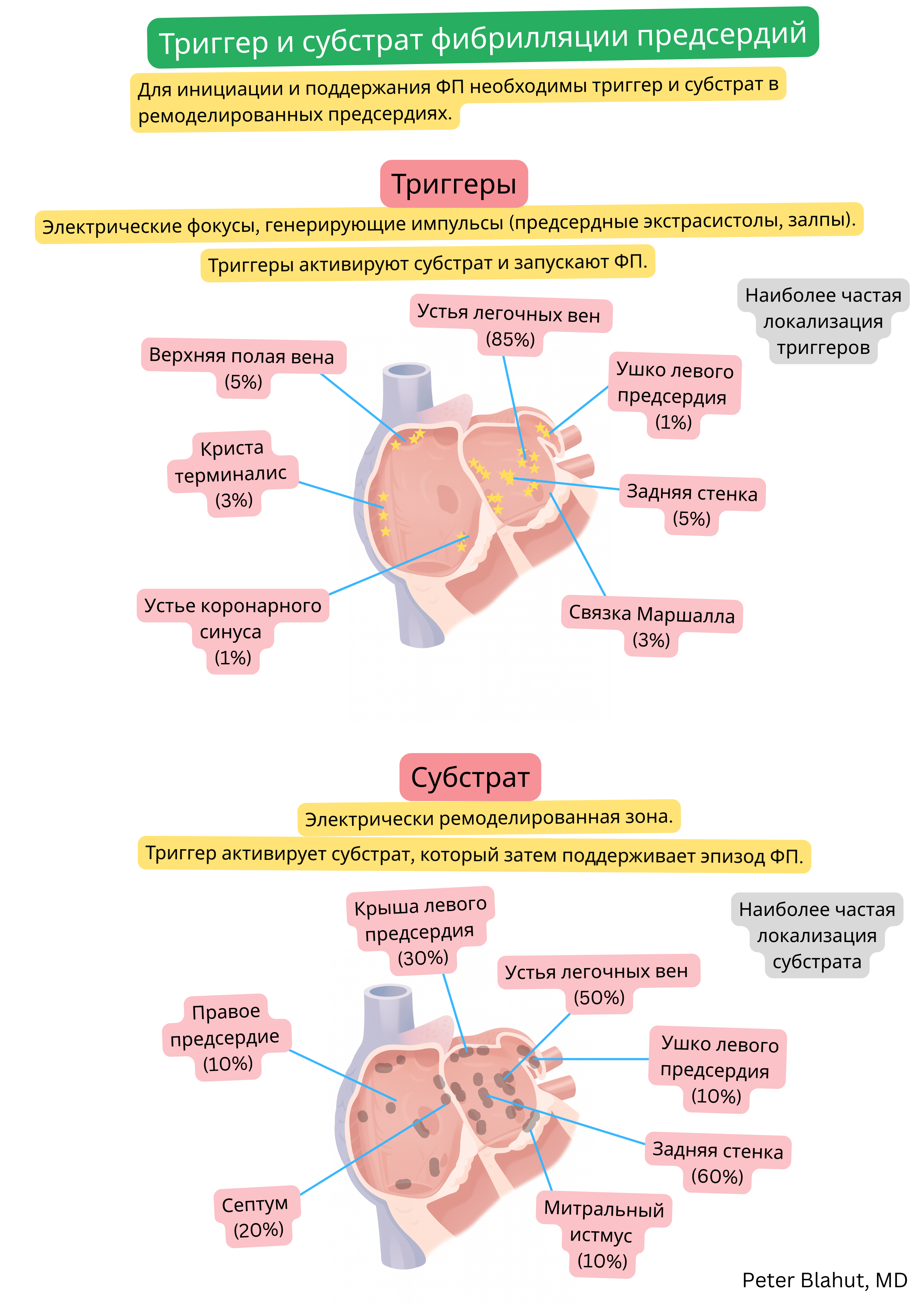 Схема локализации триггеров и аритмогенного субстрата фибрилляции предсердий с выделением устьев легочных вен, задней стенки левого предсердия и других анатомических областей, участвующих в инициации и поддержании аритмии.