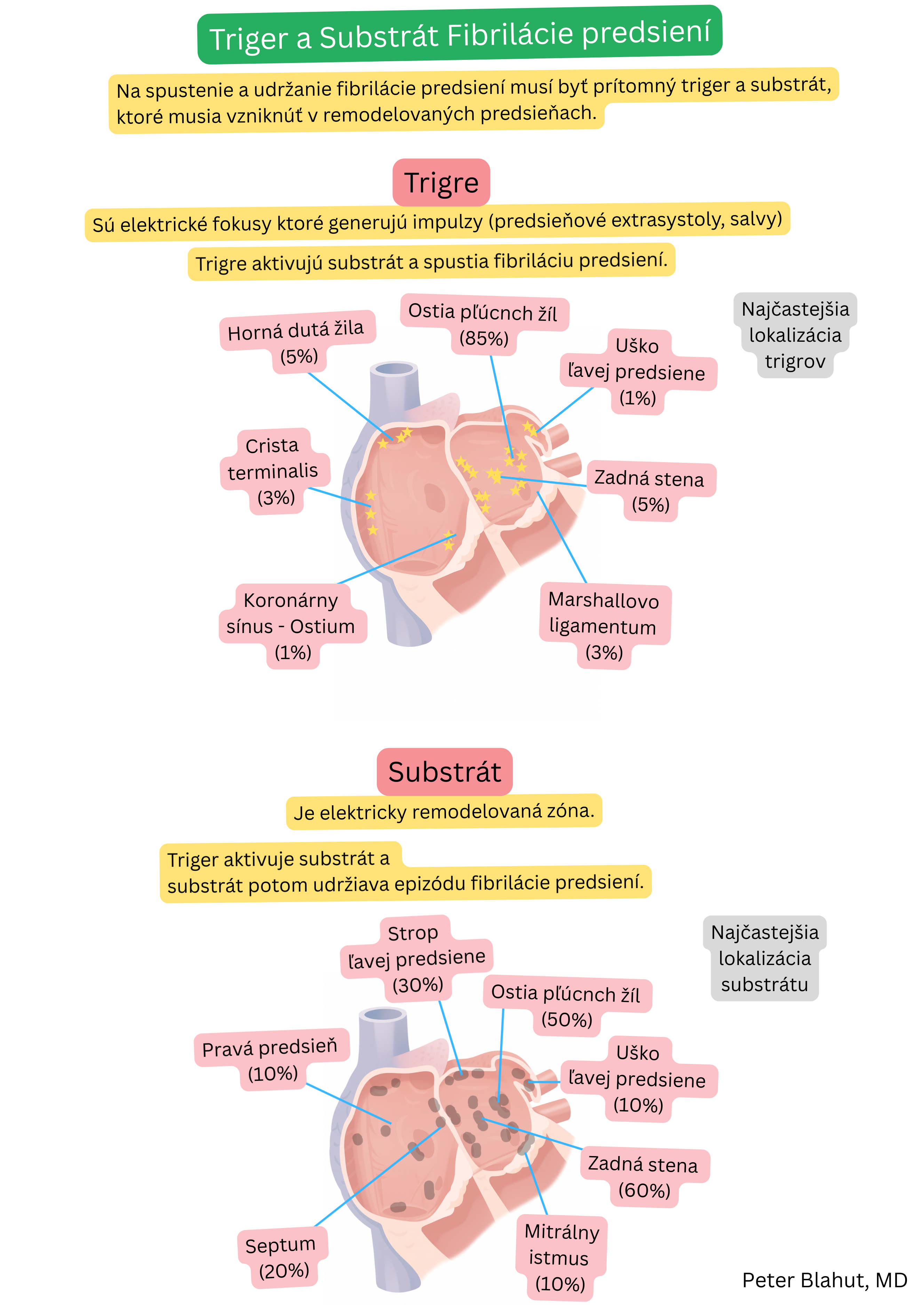 Schéma lokalizácie triggerov a arytmogénneho substrátu fibrilácie predsiení so zvýraznením ostií pľúcnych žíl, zadnej steny ľavej predsiene a ďalších anatomických oblastí podieľajúcich sa na iniciácii a udržiavaní arytmie.