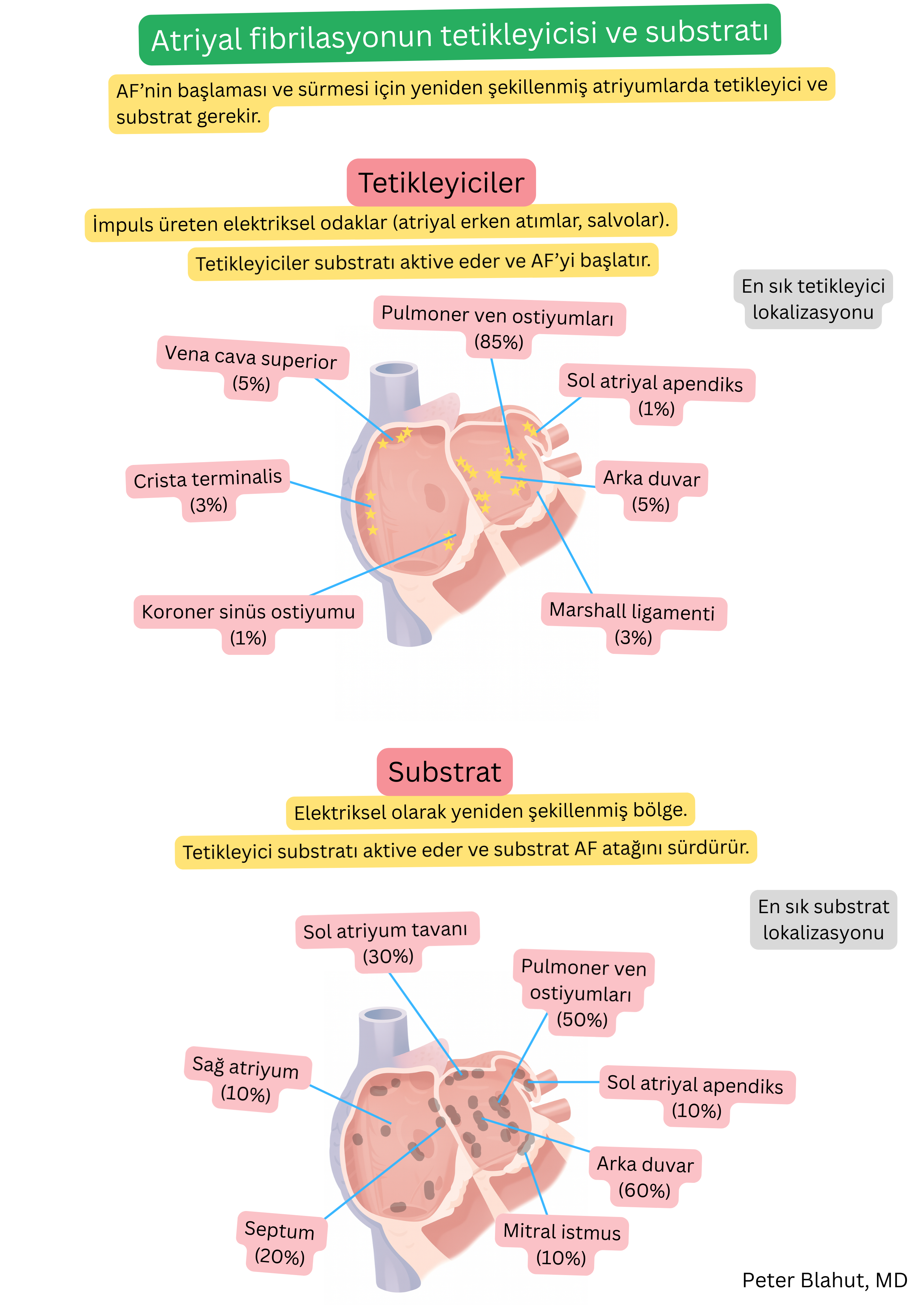 Atriyal fibrilasyonun tetikleyicileri ve aritmojenik substratının lokalizasyonunu gösteren, pulmoner ven ostiumları, sol atriyumun posterior duvarı ve aritminin başlangıç ve sürdürülmesinde rol oynayan diğer anatomik bölgeleri vurgulayan şema.