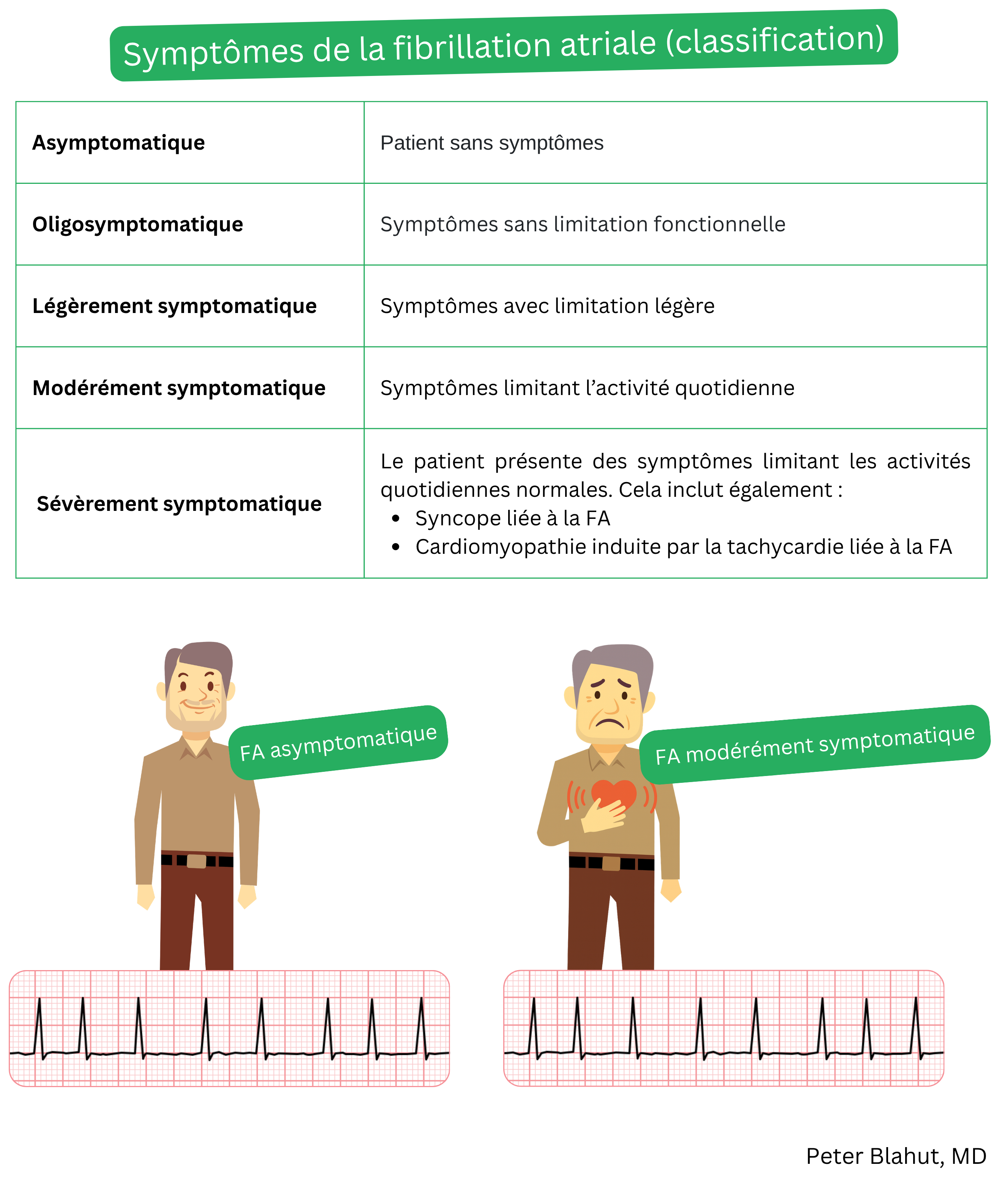 Tableau de classification de la sévérité des symptômes de la fibrillation auriculaire selon le degré de charge symptomatique, des formes asymptomatiques aux formes très symptomatiques, avec les conséquences cliniques associées.
