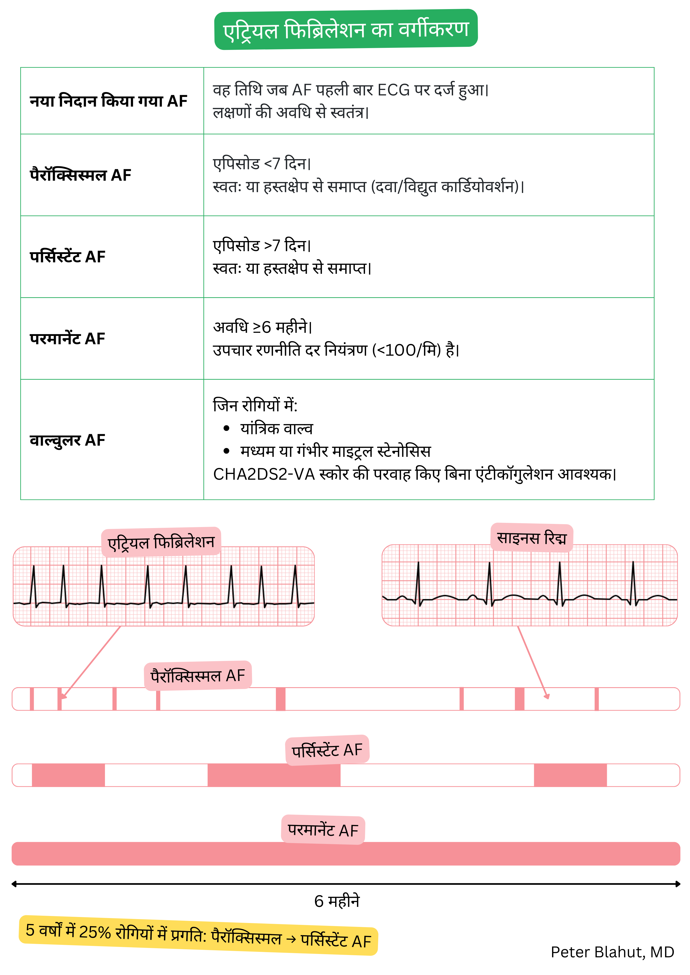 एट्रियल फिब्रिलेशन का वर्गीकरण दर्शाने वाली तालिका, जिसमें नव-निदानित, पैरॉक्सिस्मल, पर्सिस्टेंट, परमानेंट और वाल्वुलर रूप शामिल हैं, साथ में एट्रियल फिब्रिलेशन और साइनस रिद्म के ईसीजी का तुलनात्मक चित्रण।