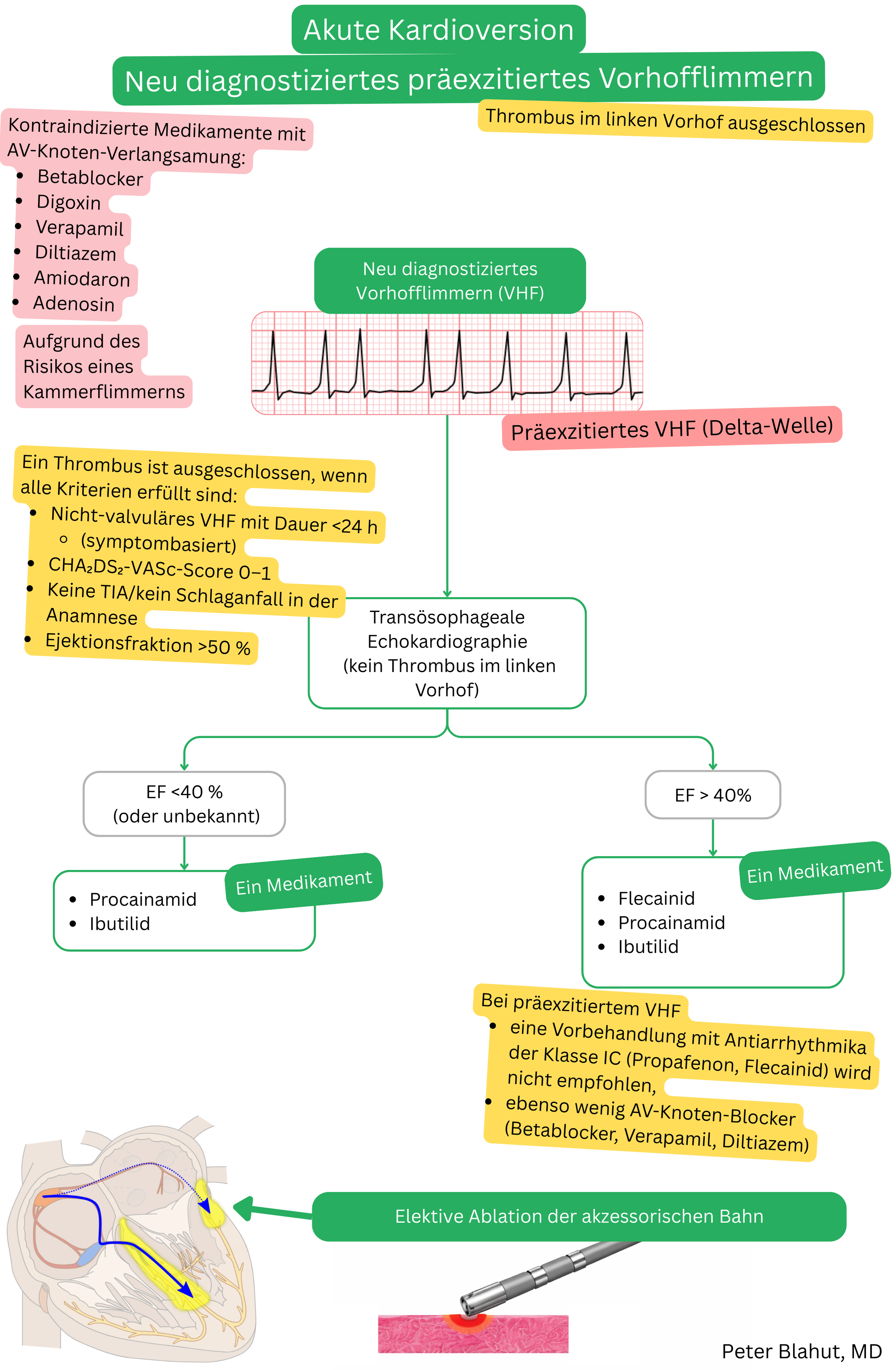 Algorithmus zur akuten Kardioversion bei neu diagnostiziertem präexzitiertem Vorhofflimmern nach Ausschluss eines Thrombus im linken Vorhof mit Kontraindikation von AV-Knoten-blockierenden Medikamenten und Empfehlung von Antiarrhythmika oder Ablation der akzessorischen Leitungsbahn.