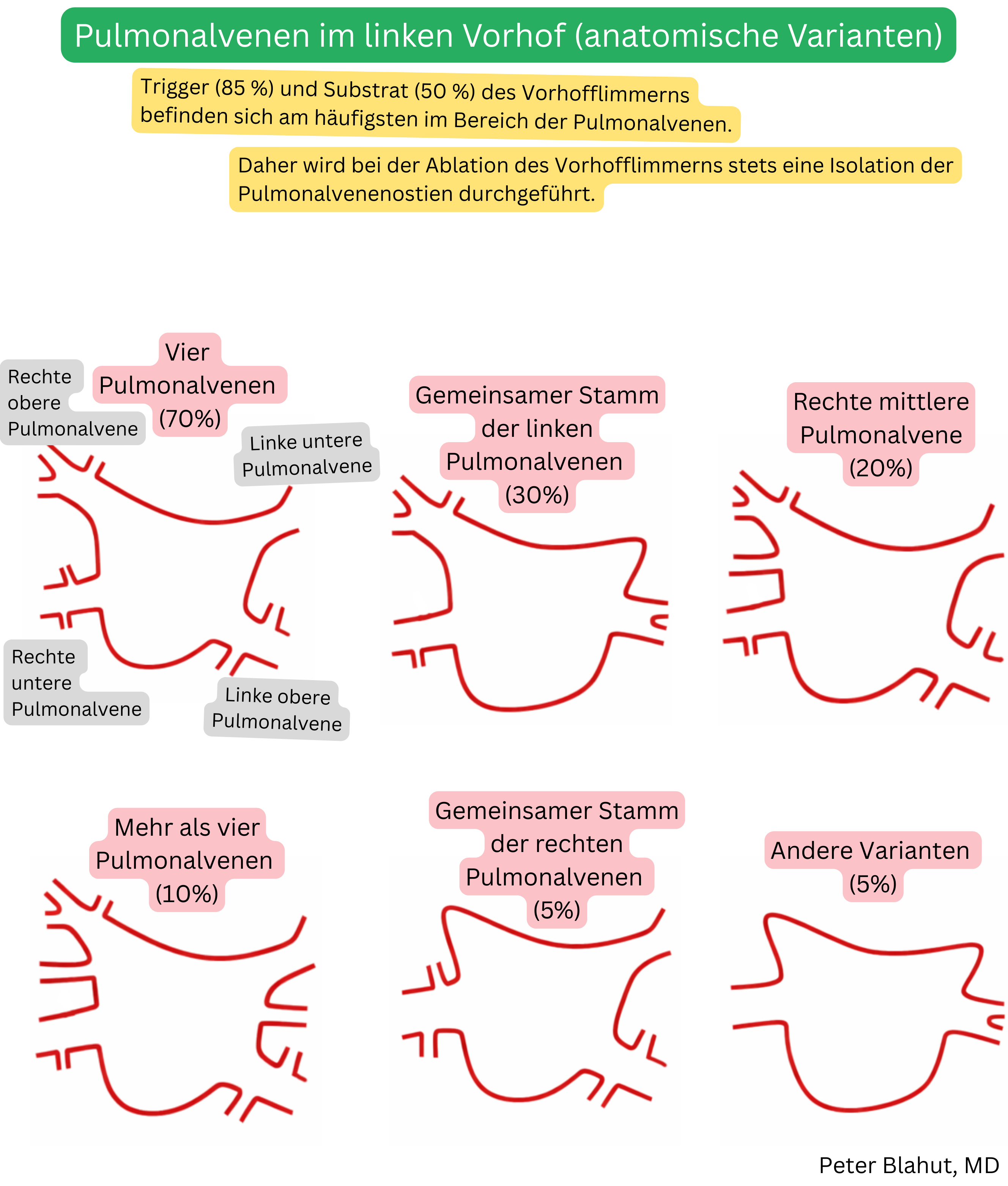 Überblick über anatomische Varianten der in den linken Vorhof mündenden Pulmonalvenen einschließlich der häufigsten Vier-Venen-Konfiguration, gemeinsamer linker oder rechter Stamm und weiterer Variationen mit Angabe ihrer Prävalenz.