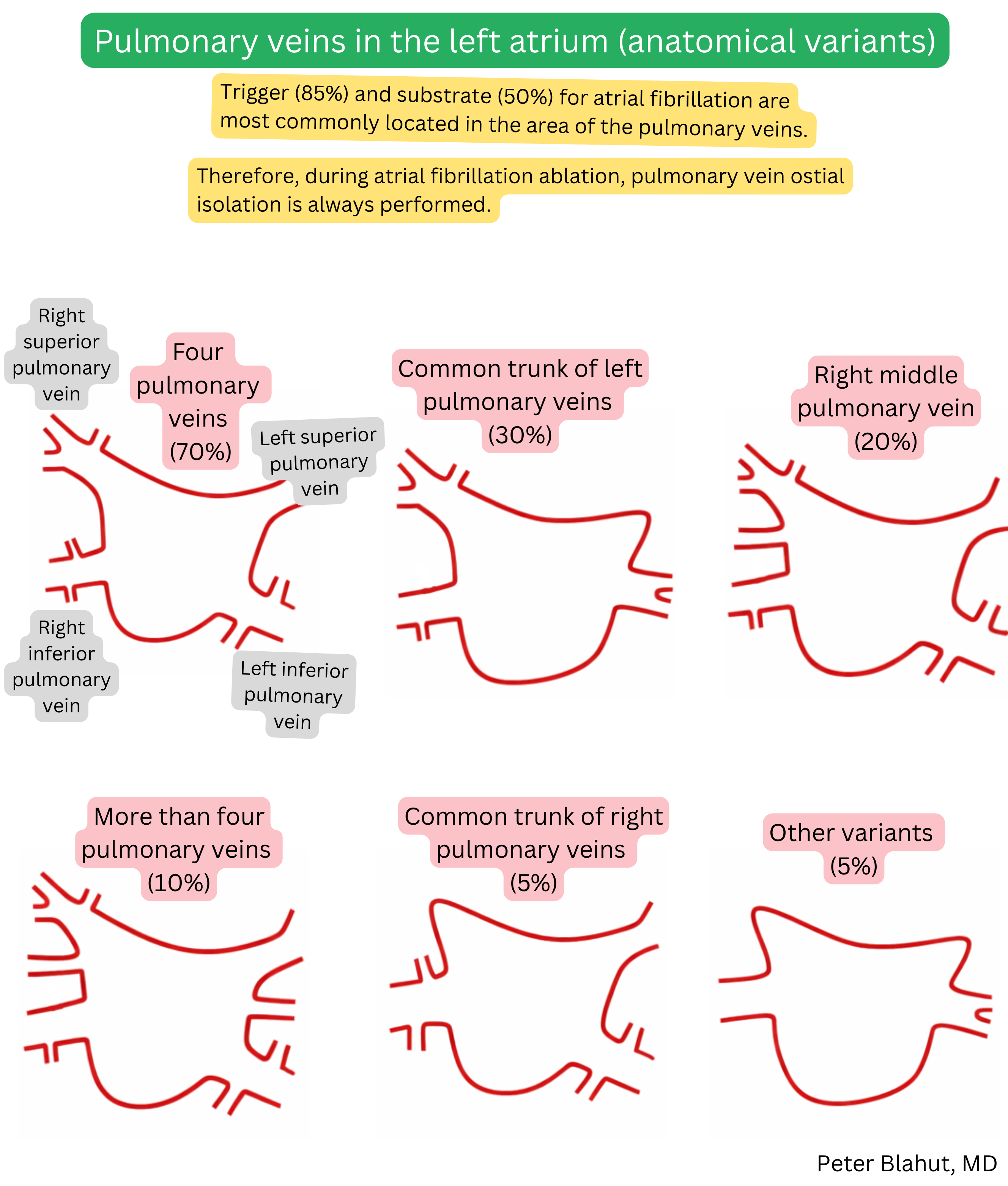 Overview of anatomical variants of pulmonary veins draining into the left atrium including the most common four-vein pattern, common left or right trunks and other variations with their reported prevalence.