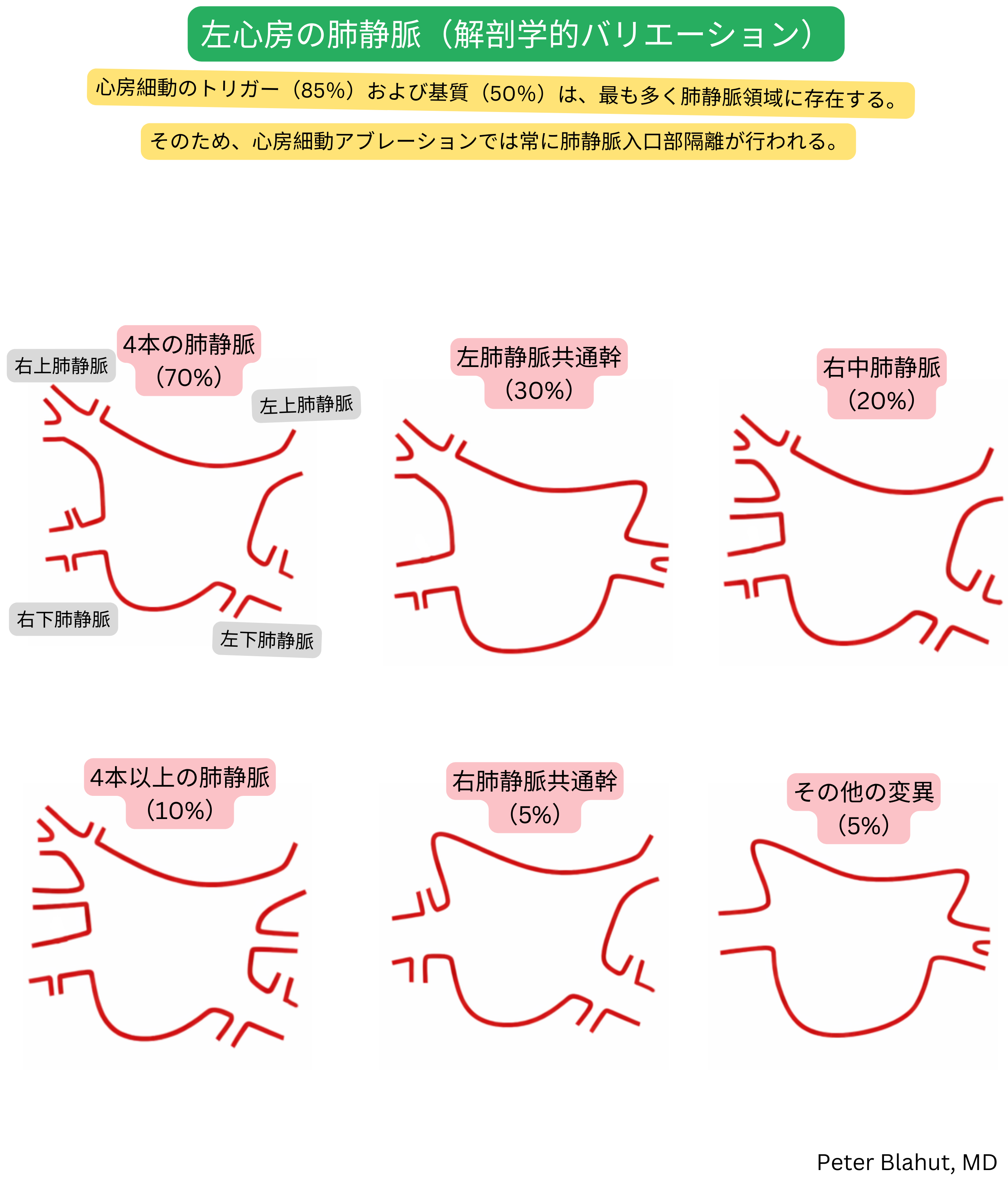 左心房に流入する肺静脈の解剖学的バリエーションの概要で、最も一般的な4本型、左または右の共通幹およびその他の変異とその頻度を含む。