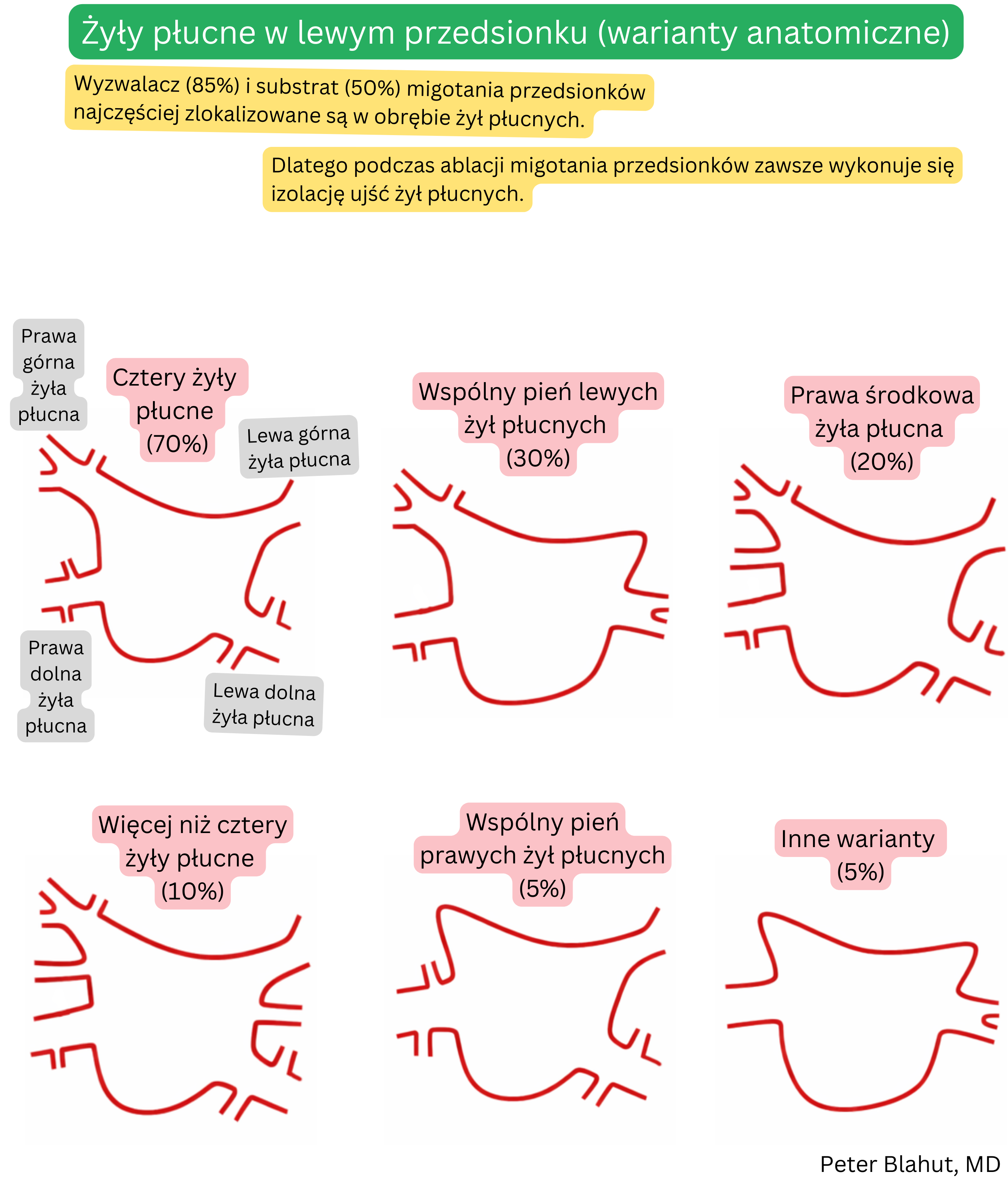 Przegląd wariantów anatomicznych żył płucnych uchodzących do lewego przedsionka obejmujący najczęstszy układ czterech żył, wspólny pień lewy lub prawy oraz inne odmiany wraz z ich częstością.
