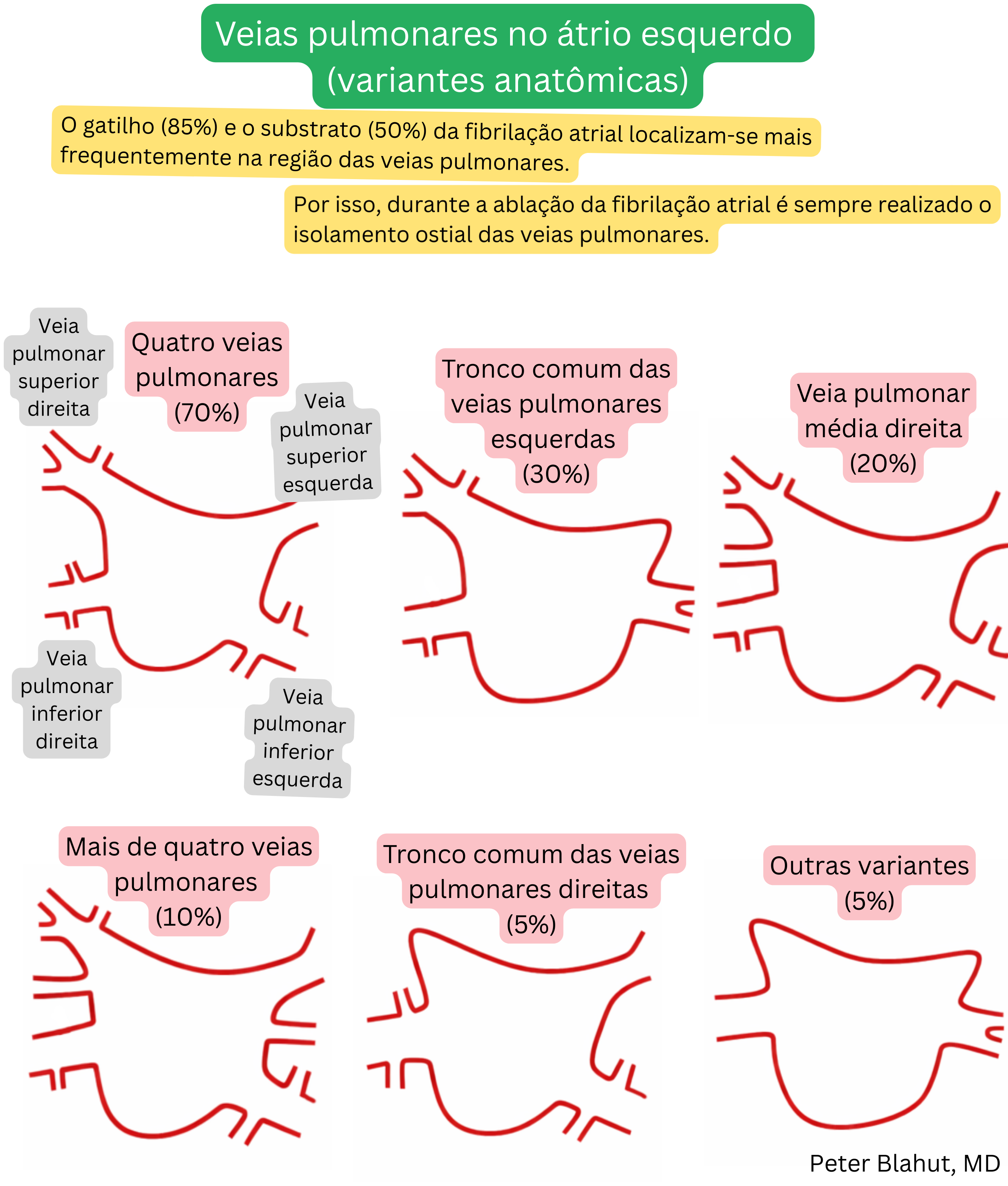 Visão geral das variantes anatômicas das veias pulmonares que drenam para o átrio esquerdo, incluindo o padrão mais comum com quatro veias, tronco comum esquerdo ou direito e outras variações com sua prevalência.
