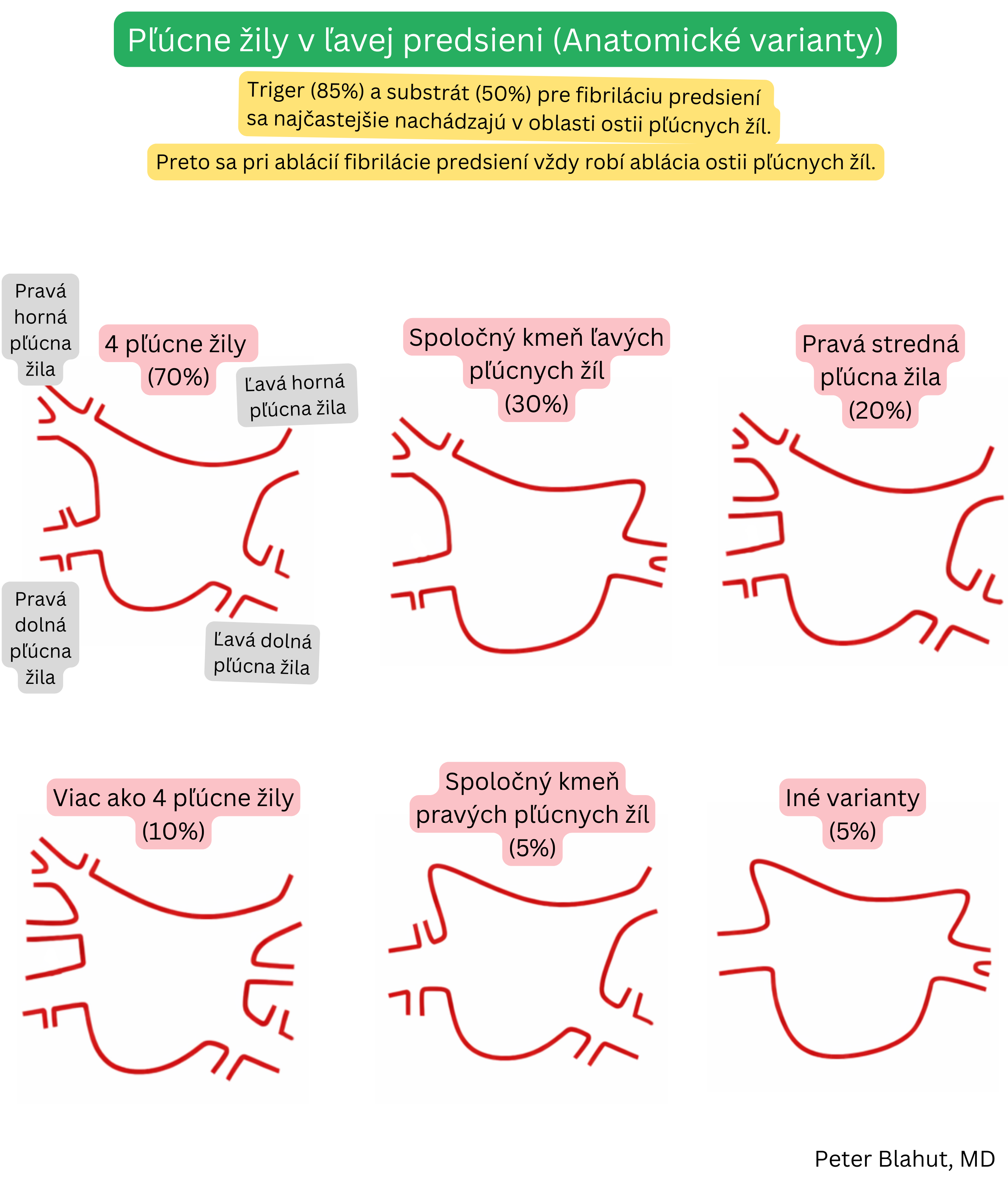 Prehľad anatomických variantov pľúcnych žíl ústiacich do ľavej predsiene vrátane najčastejšieho usporiadania so štyrmi žilami, spoločného kmeňa ľavých alebo pravých žíl a ďalších variácií s uvedením ich frekvencie.