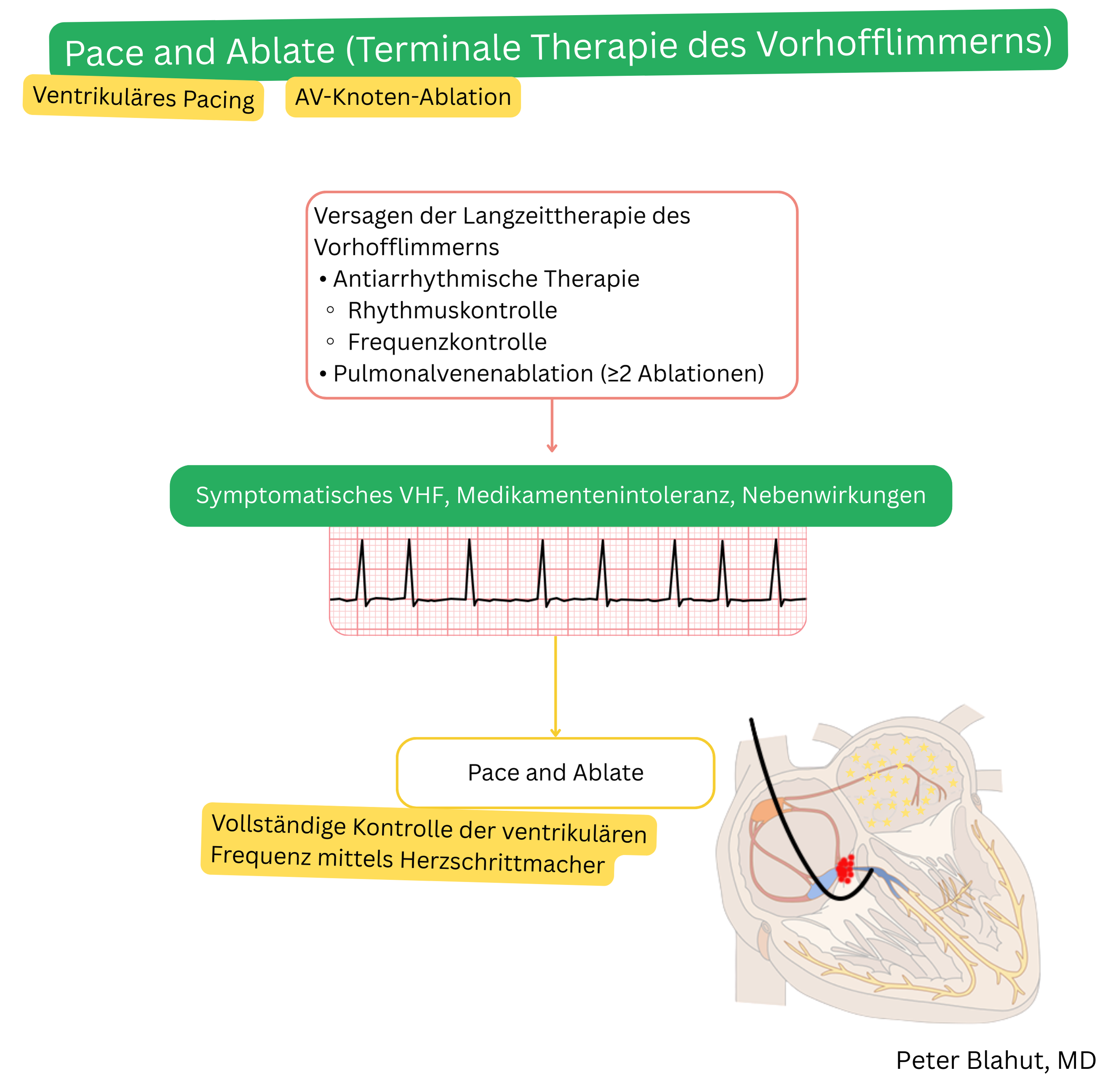 Schema der Pace-and-Ablate-Strategie bei terminaler Behandlung des Vorhofflimmerns nach Versagen antiarrhythmischer Therapie und wiederholter Ablationen mit AV-Knoten-Ablation und anschließender permanenter ventrikulärer Stimulation zur vollständigen Frequenzkontrolle.