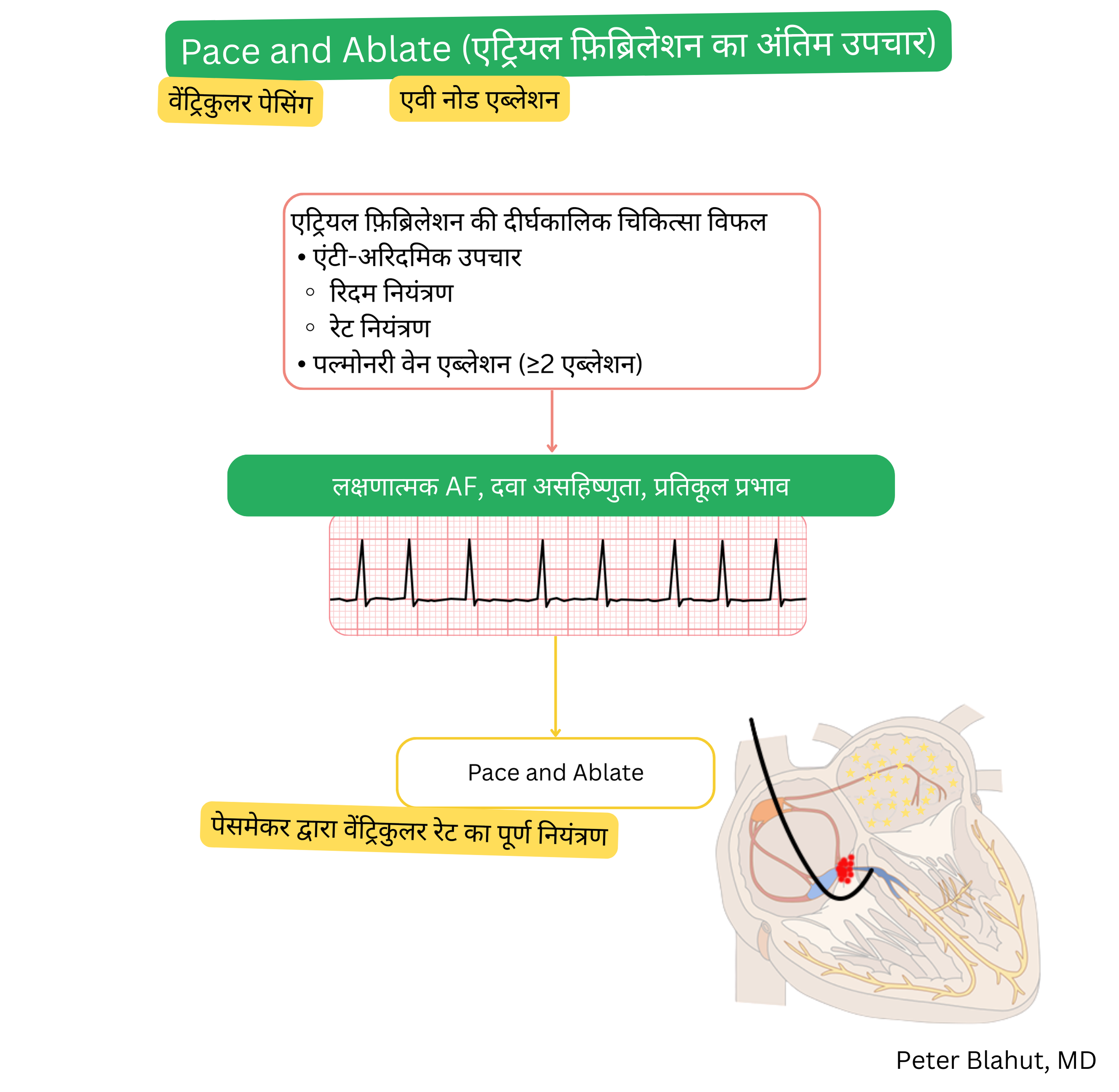 टर्मिनल एट्रियल फिब्रिलेशन में ‘पेस एंड एब्लेट’ रणनीति का आरेख, जो एंटीअरिद्मिक उपचार और बार-बार एब्लेशन की विफलता के बाद संकेतित है, जिसमें AV नोड एब्लेशन और पूर्ण दर नियंत्रण हेतु स्थायी वेंट्रिकुलर पेसिंग शामिल है।