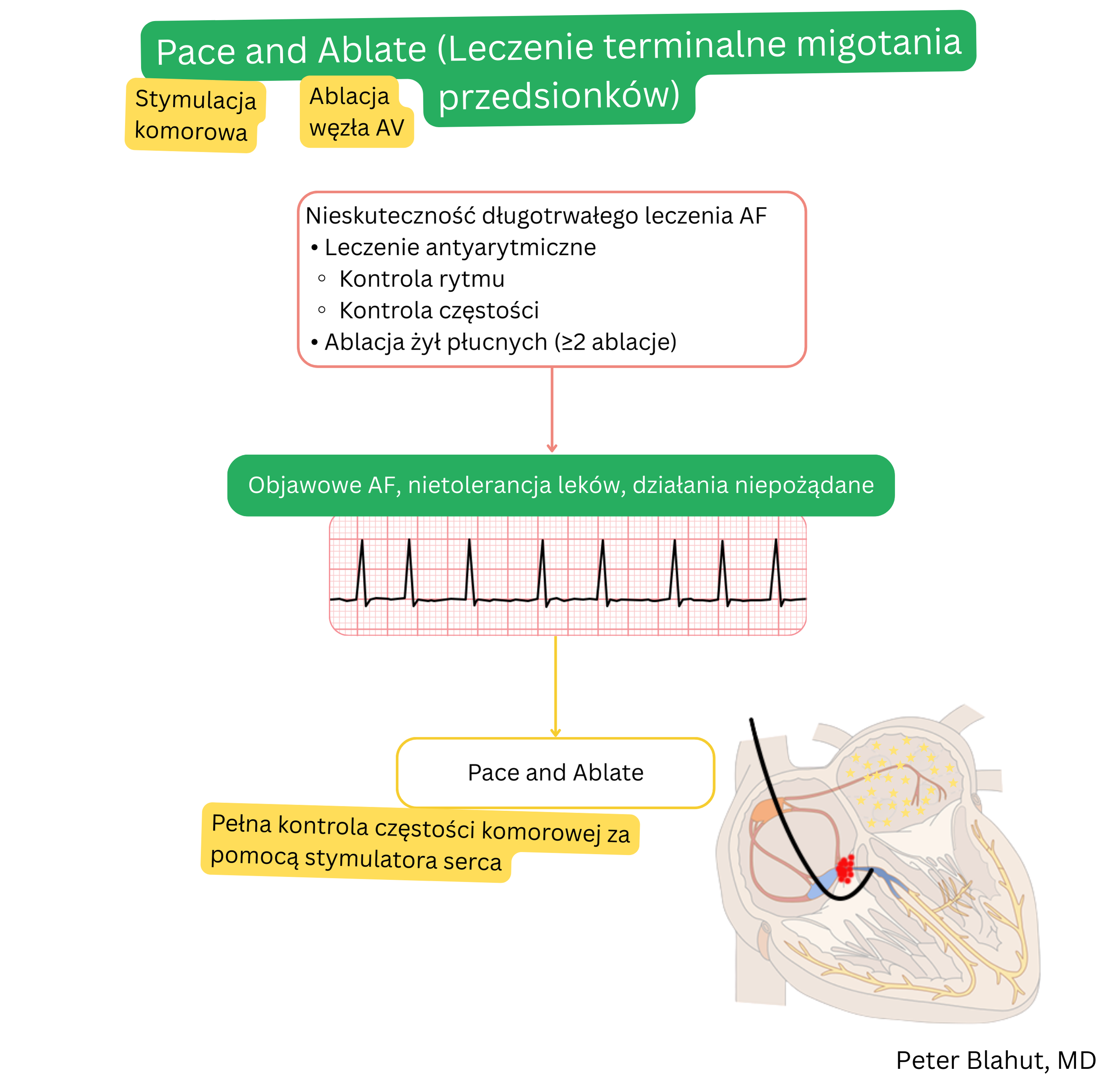 Schemat strategii pace and ablate w terminalnym leczeniu migotania przedsionków wskazanej po nieskuteczności terapii antyarytmicznej i powtarzanych ablacji, obejmującej ablację węzła AV oraz następową stałą stymulację komorową w celu pełnej kontroli częstości.